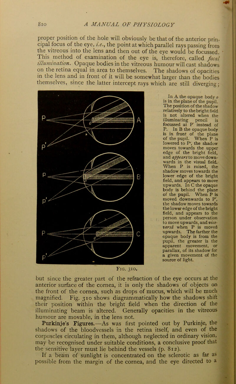 proper position of the hole will obviously be that of the anterior prin- cipal focus of the eye, i.e., the point at which parallel rays passing from the vitreous into the lens and then out of the eye would be focussed. • This method of examination of the eye is, therefore, called focal illumination. Opaque bodies in the vitreous humour will cast shadows on the retina equal in area to themselves. The shadows of opacities in the lens and in front of it will be somewhat larger than the bodies themselves, since the latter intercept rays which are still diverging; In A the opaque body o is in the plane of the pupil. The position of the shadow relatively to the bright field is not altered when the illuminating pencil is focussed at P' instead of P. In B the opaque body is in front of the plane of the pupil. When P is lowered to P', the shadow moves towards the upper edge of the bright field, and appears to move down- wards in the visual field. When P is raised, the shadow moves towards the lower edge of the bright field, and appears to move upwards. In C the opaque body is behind the plane of the pupil. When P is moved downwards to P', the shadow moves towards the lower edge of the bright field, and appears to the person under observation to move upwards, and vice- versa when P is moved upwards. The farther the opaque body is from the pupil, the greater is the apparent movement, or parallax, of its shadow for a given movement of the source of light. but since the greater part of the refraction of the eye occurs at the anterior surface of the cornea, it is only the shadows of objects on the front of the cornea, such as drops of mucus, which will be much magnified. Fig. 310 shows diagrammatically how the shadows shift their position within the bright field when the direction of the illuminating beam is altered. Generally opacities in the vitreous humour are movable, in the lens not. Purkinje’s Figures.—As was first pointed out by Purkinje, the shadows of the bloodvessels in the retina itself, and even of the corpuscles circulating in them, although neglected in ordinary vision, may be recognised under suitable conditions, a conclusive proof that the sensitive layer must lie behind the vessels (p. 812). If a beam of sunlight is concentrated on the sclerotic as far as possible from the margin of the cornea, and the eye directed to a Fig. 310.