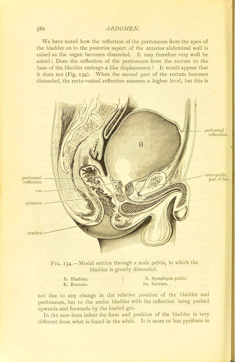 We have noted how the reflection of the peritoneum from the apex of the bladder on to the posterior aspect of the anterior abdominal wall is raised as the organ becomes distended. It may therefore very well be asked : Does the reflection of the peritoneum from the rectum to the base of the bladder undergo a like displacement ? It would appear that it does not (Fig. 134). When the second part of the rectum becomes distended, the recto-vesical reflection assumes a higher level, but this is peritoneal reflection. retro-pubic pad of fat. Fig. 134.—Mesial section through a male pelvis, in which the bladder is greatly distended. B. Bladder. S. Symphysis pubis. R. Rectum. ' Sa. Sacrum. not due to any change in the relative position of the bladder and peritoneum, but to the entire bladder with the reflection being pushed upwards and forwards by the loaded gut. In the new-born infant the form and position of the bladder is very different from what is found in the adult. It is more or less pyriform in