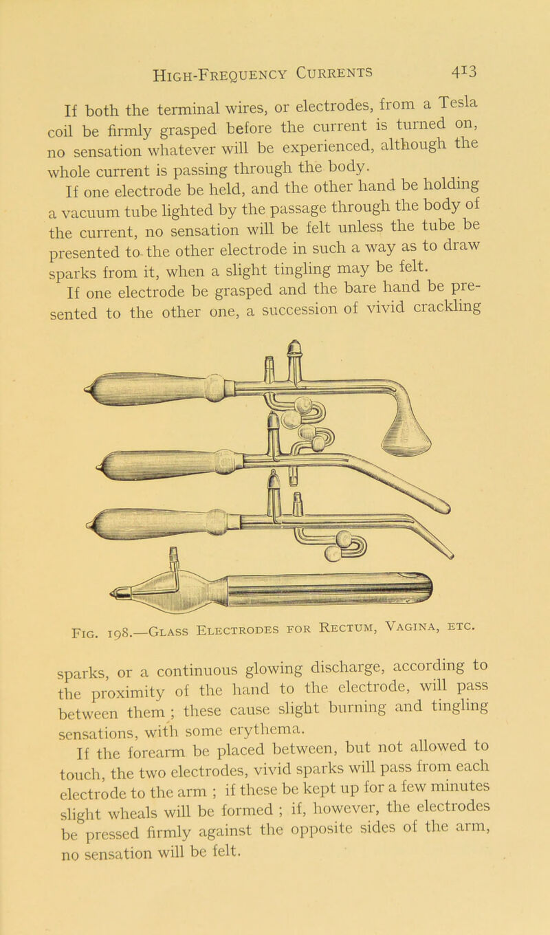 If both the terminal wires, or electrodes, from a Tesla coil be firmly grasped before the current is turned on, no sensation whatever will be experienced, although the whole current is passing through the body. If one electrode be held, and the other hand be holding a vacuum tube lighted by the passage through the body of the current, no sensation will be felt unless the tube be presented to- the other electrode in such a way as to draw sparks from it, when a slight tingling may be felt. If one electrode be grasped and the bare hand be pre- sented to the other one, a succession of vivid crackling Fig. 198. Glass Electrodes for Rectum, Vagina, etc sparks, or a continuous glowing discharge, according to the proximity of the hand to the electrode, will pass between them; these cause slight burning and tingling sensations, with some eiythema. If the forearm be placed between, but not allowed to touch, the two electrodes, vivid sparks will pass from each electrode to the arm ; if these be kept up for a few minutes slight wheals will be formed ; if, however, the electrodes be pressed firmly against the opposite sides of the arm, no sensation will be felt.