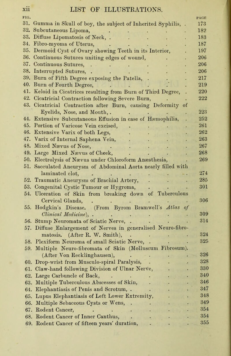 FIG. PAGE 31. Gumma in Skull of boy, the subject of Inherited Syphilis, . 173 32. Subcutaneous Lipoma, . . . . .182 33. Diffuse Lipomatosis of Neck, ..... 183 34. Fibre-myoma of Uterus, ..... 187 35. Dermoid Cyst of Ovary showing Teeth in its Interior, . 197 36. Continuous Sutures uniting edges of wound, . . 206 37. Continuous Sutures, ...... 206 38. Interrupted Sutures, ...... 206 39. Burn of Fifth Degree exposing the Patella, . . . 217 40. Burn of Fourth Degree, ..... 219 41. Keloid in Cicatrices resulting from Burn of Third Degree, . 220 42. Cicatricial Contraction following Severe Burn, . . 222 43. Cicatricial Contraction after Burn, causing Deformity of Eyelids, Nose, and Mouth, ..... 223 44. Extensive Subcutaneous Effusion in case of Hemophilia, . 252 45. Portion of Varicose Vein excised, .... 261 46. Extensive Varix of both Legs, .... 262 47. Varix of Internal Saphena Vein, .... 263 48. Mixed Naevus of Nose, ..... 267 49. Large Mixed Nevus of Cheek, .... 268 50. Electrolysis of Nevus under Chloroform Anesthesia, . 269 51. Sacculated Aneurysm of Abdominal Aorta nearly filled with laminated clot, . . . . . .274 52. Traumatic Aneurysm of Brachial Artery, . . . 285 53. Congenital Cystic Tumour or Hygroma, . . . 301 54. Ulceration of Skin from breaking down of Tuberculous Cervical Glands, ...... 306 55. Hodgkin’s Disease. (From Byrom Bramwell’s Atlas of Clinical Medicine), ...... 309 56. Stump Neuromata of Sciatic Nerve, .... 314 57. Diffuse Enlargement of Nerves in generalised Neuro-fibro- matosis. (After R. W. Smith), .... 324 58. Plexiform Neuroma of small Sciatic Nerve, . . . 325 59. Multiple Neuro-fibromata of Skin (Molluscum Fibrosum). (After Von Recklinghausen), .... 326 60. Drop-wrist from Musculo-spiral Paralysis, . . ,. 328 61. Claw-hand following Division of Ulnar Nerve, . . 330 62. Large Carbuncle of Back, ..... 340 63. Multiple Tuberculous Abscesses of Skin, . . • 346 64. Elephantiasis of Penis and Scrotum, .... 347 65. Lupus Elephantiasis of Left Lower Extremity, . . 348 66. Multiple Sebaceous Cysts or Wens, .... 349 67. Rodent Cancer, ...... 354 68. Rodent Cancer of Inner Cantlius, .... 354 69. Rodent Cancer of fifteen years’ duration, . . . 355