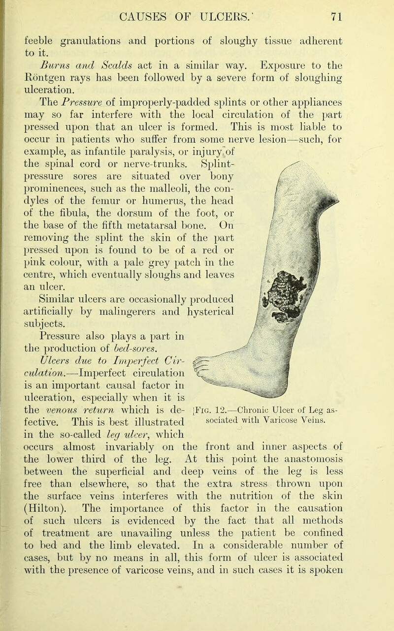 feeble granulations and portions of sloughy tissue adherent to it. Barns and Scalds act in a similar way. Exposure to the Rontgen rays has been followed by a severe form of sloughing ulceration. The Pressure of improperly-padded splints or other appliances may so far interfere with the local circulation of the part pressed upon that an ulcer is formed. This is most liable to occur in patients who suffer from some nerve lesion—such, for example, as infantile paralysis, or injury (of the spinal cord or nerve-trunks. Splint- pressure sores are situated over bony prominences, such as the malleoli, the con- dyles of the femur or humerus, the head of the fibula, the dorsum of the foot, or the base of the fifth metatarsal bone. On removing the splint the skin of the part pressed upon is found to be of a red or pink colour, with a pale grey patch in the centre, which eventually sloughs and leaves an ulcer. Similar ulcers are occasionally produced artificially by malingerers and hysterical subjects. Pressure also plays a part in the production of bed-sores. Ulcers due to Imperfect Cir- culation.—Imperfect circulatioi is an important causal factor ii ulceration, especially when it L the venous return which is de- fective. This is best illustrated in the so-called leg ulcer, which occurs almost invariably on the front and inner aspects of the lower third of the leg. At this point the anastomosis between the superficial and deep veins of the leg is less free than elsewhere, so that the extra stress thrown upon the surface veins interferes with the nutrition of the skin (Hilton). The importance of this factor in the causation of such ulcers is evidenced by the fact that all methods of treatment are unavailing unless the patient be confined to bed and the limb elevated. In a considerable number of cases, but by no means in all, this form of ulcer is associated with the presence of varicose veins, and in such cases it is spoken [Fig. 12.—Chronic Ulcer of Leg as- sociated with Varicose Veins.