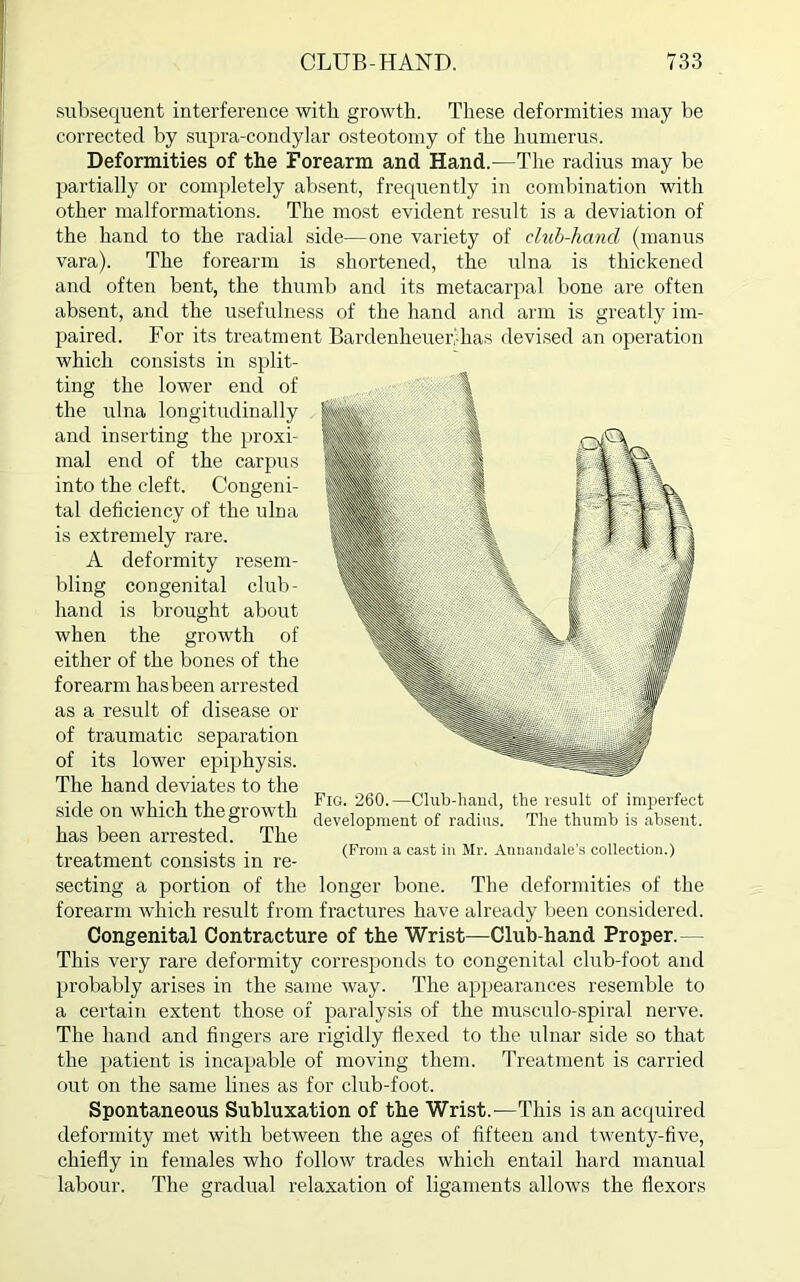 subsequent interference with growth. These deformities may be corrected by supra-condylar osteotomy of the humerus. Deformities of the Forearm and Hand.—The radius may be partially or completely absent, frequently in combination with other malformations. The most evident result is a deviation of the hand to the radial side—one variety of club-hand (manus vara). The forearm is shortened, the idna is thickened and often bent, the thumb and its metacarpal bone are often absent, and the usefulness of the hand and arm is greatly im- paired. For its treatment Bardenheueivhas devised an operation which consists in split- ting the lower end of the ulna longitudinally and inserting the proxi- mal end of the carpus into the cleft. Congeni- tal deficiency of the ulna is extremely rare. A deformity resem- bling congenital club- hand is brought about when the growth of either of the bones of the forearm has been arrested as a result of disease or of traumatic separation of its lower epiphysis. The hand deviates to the side on which the growth has been arrested. The , , , ... (From a cast in Mr. Annandale's collection.) treatment consists in re- secting a portion of the longer bone. The deformities of the forearm which result from fractures have already been considered. Congenital Contracture of the Wrist—Club-hand Proper.— This very rare deformity corresponds to congenital club-foot and probably arises in the same way. The appearances resemble to a certain extent those of paralysis of the musculo-spiral nerve. The hand and fingers are rigidly flexed to the ulnar side so that the patient is incapable of moving them. Treatment is carried out on the same lines as for club-foot. Spontaneous Subluxation of the Wrist.—This is an acquired deformity met with between the ages of fifteen and twenty-five, chiefly in females who follow trades which entail hard manual relaxation of ligaments allows the flexors Fig. 260.—Club-hand, the result of imperfect development of radius. The thumb is absent. labour. The gradual