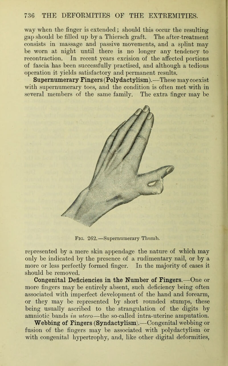 way when the finger is extended; should this occur the resulting gap should be filled up by a Thiersch graft. The after-treatment consists in massage and passive movements, and a splint may be worn at night until there is no longer any tendency to recontraction. In recent years excision of the affected portions of fascia has been successfully practised, and although a tedious operation it yields satisfactory and permanent results. Supernumerary Fingers (Polydactylism).—These may coexist with supernumerary toes, and the condition is often met with in several members of the same family. The extra finger may be Fig. 262.—Supernumerary Thumb. represented by a mere skin appendage the nature of which may only be indicated by the presence of a rudimentary nail, or by a more or less perfectly formed finger. In the majority of cases it should be removed. Congenital Deficiencies in the Number of Fingers.—One or more fingers may be entirely absent, such deficiency being often associated with imperfect development of the hand and forearm, or they may be represented by short rounded stumps, these being usually ascribed to the strangulation of the digits by amniotic bands in utero—the so-called intra-uterine amputation. Webbing of Fingers (Syndactylism).—Congenital webbing or fusion of the fingers may be associated with polydactylism or with congenital hypertrophy, and, like other digital deformities,