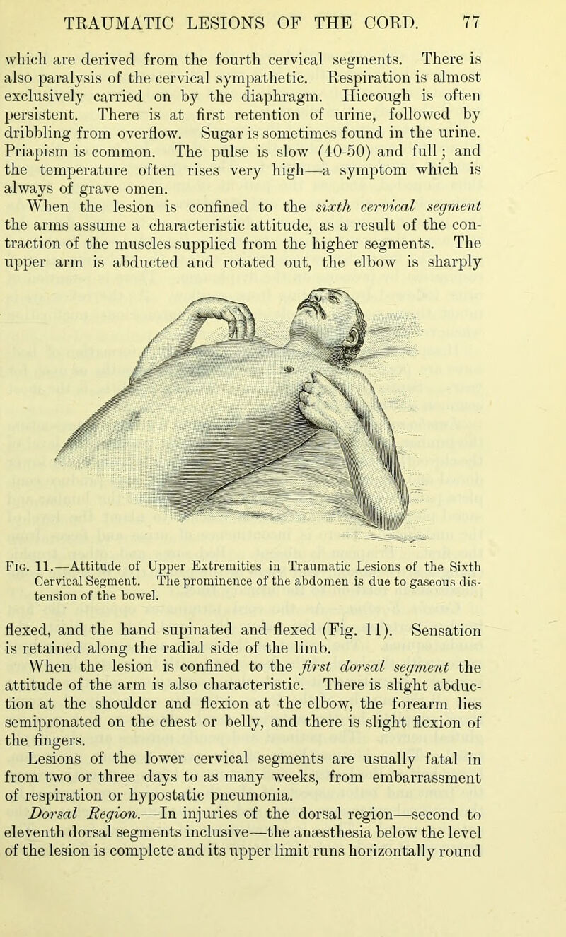 which are derived from the fourth cervical segments. There is also paralysis of the cervical sympathetic. Respiration is almost exclusively carried on by the diaphragm. Hiccough is often persistent. There is at first retention of urine, followed by dribbling from overflow. Sugar is sometimes found in the urine. Priapism is common. The pulse is slow (40-50) and full; and the temperature often rises very high—a symptom which is always of grave omen. When the lesion is confined to the sixth cervical segment the arms assume a characteristic attitude, as a result of the con- traction of the muscles supplied from the higher segments. The upper arm is abducted and rotated out, the elbow is sharply Fig. 11.—Attitude of Upper Extremities in Traumatic Lesions of the Sixth Cervical Segment. The prominence of the abdomen is due to gaseous dis- tension of the bowel. flexed, and the hand supinated and flexed (Fig. 11). Sensation is retained along the radial side of the limb. When the lesion is confined to the first dorsal segment the attitude of the arm is also characteristic. There is slight abduc- tion at the shoulder and flexion at the elbow, the forearm lies semipronated on the chest or belly, and there is slight flexion of the fingers. Lesions of the lower cervical segments are usually fatal in from two or three days to as many weeks, from embarrassment of respiration or hypostatic pneumonia. Dorsal Region.—In injuries of the dorsal region—second to eleventh dorsal segments inclusive—the anaesthesia below the level of the lesion is complete and its upper limit runs horizontally round