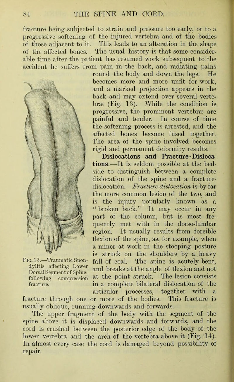 fracture being' subjected to strain and pressure too early, or to a progressive softening of the injured vertebra and of the bodies of those adjacent to it. This leads to an alteration in the shape of the affected bones. The usual history is that some consider- able time after the patient has resumed work subsequent to the accident he suffers from pain in the back, and radiating pains round the body and down the legs. He becomes more and more unfit for work, and a marked projection appears in the back and may extend over several verte- brae (Fig. 13). While the condition is progressive, the prominent vertebrae are painful and tender. In course of time the softening process is arrested, and the affected bones become fused together. The area of the spine involved becomes rigid and permanent deformity results. Dislocations and Fracture-Disloca- tions.—It is seldom possible at the bed- side to distinguish between a complete dislocation of the spine and a fracture- dislocation. Fracture-dislocation is by far the more common lesion of the two, and is the injury popularly known as a “ broken back.” It may occur in any part of the column, but is most fre- quently met with in the dorso-lumbar region. It usually results from forcible flexion of the spine, as, for example, when a miner at work in the stooping posture is struck on the shoulders by a heavy Fig. 13.—Traumatic Spon- faJ| 0f coal. The spine is acutely bent, dylitis affecting Lower ancj preaps the angle of flexion and not following compression at the point struck. Ihe lesion consists fracture. in a complete bilateral dislocation of the articular processes, together with a fracture through one or more of the bodies. This fracture is usually oblique, running downwards and forwards. The upper fragment of the body with the segment of the spine above it is displaced downwards and forwards, and the cord is crushed between the posterior edge of the body of the lower vertebra and the arch of the vertebra above it (Fig. 14). In almost every case the cord is damaged beyond possibility of repair.