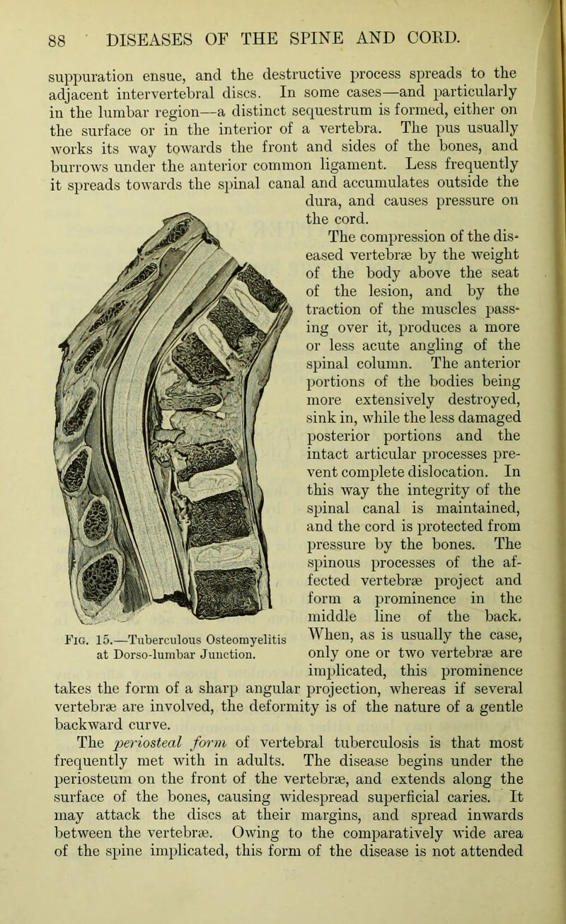 suppuration ensue, and the destructive process spreads to the adjacent intervertebral discs. In some cases—and particularly in the lumbar region—a distinct sequestrum is formed, either on the surface or in the interior of a vertebra. The pus usually works its way towards the front and sides of the bones, and burrows under the anterior common ligament. Less frequently it spreads towards the spinal canal and accumulates outside the dura, and causes pressure on the cord. The compression of the dis- eased vertebrae by the weight of the body above the seat of the lesion, and by the traction of the muscles pass- ing over it, produces a more or less acute angling of the spinal column. The anterior portions of the bodies being more extensively destroyed, sink in, while the less damaged posterior portions and the intact articular processes pre- vent complete dislocation. In this way the integrity of the spinal canal is maintained, and the cord is protected from pressure by the bones. The spinous processes of the af- fected vertebrae project and form a prominence in the middle line of the back. Fig. 15.—Tuberculous Osteomyelitis ^ hen, as is usually the case, at Dorso-lumbar Junction. only one or two vertebrae are implicated, this prominence takes the form of a sharp angular projection, whereas if several vertebrae are involved, the deformity is of the nature of a gentle backward curve. The periosteal form of vertebral tuberculosis is that most frequently met with in adults. The disease begins under the periosteum on the front of the vertebrae, and extends along the surface of the bones, causing widespread superficial caries. It may attack the discs at their margins, and spread inwards between the vertebrae. Owing to the comparatively wide area of the spine implicated, this form of the disease is not attended