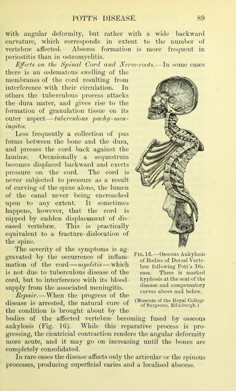 with angular deformity, but rather with a wide backward curvature, which corresponds in extent to the number of vertebras affected. Abscess formation is more frequent in periostitis than in osteomyelitis. Effects on the Spinal Cord and Nerve-roots.—In some cases there is an cedematous swelling of the membranes of the cord resulting from interference with their circulation. In others the tuberculous process attacks the dura mater, and gives rise to the formation of granulation tissue on its outer aspect — tuberculous pacht/-men- ingitis. Less frequently a collection of pus forms between the bone and the dura, and presses the cord back against the laminae. Occasionally a sequestrum becomes displaced backward and exerts pressure on the cord. The cord is never subjected to pressure as a result of curving of the spine alone, the lumen of the canal never being encroached upon to any extent. It sometimes happens, however, that the cord is nipped by sudden displacement of dis- eased vertebrae. This is practically equivalent to a fracture-dislocation of the spine. The severity of the symptoms is ag- gravated by the occurrence of inflam- mation of the cord—myelitis— which is not due to tuberculous disease of the cord, but to interference with its blood- supply from the associated meningitis. Repair.—When the progress of the disease is arrested, the natural cure of the condition is brought about by the bodies of the affected vertebrae becoming fused by osseous ankylosis (Fig. 16). While this reparative process is pro- gressing, the cicatricial contraction renders the angular deformity more acute, and it may go on increasing until the bones are completely consolidated. In rare cases the disease affects only the articular or the spinous processes, producing superficial caries and a localised abscess. Fig. 16.-—Osseous Ankylosis of Bodies of Dorsal Verte- brae following Pott’s Dis- ease. There is marked kyphosis at the seat of the disease and compensatory curves above and below. (Museum of the Royal College of Surgeons, Edinburgh.)