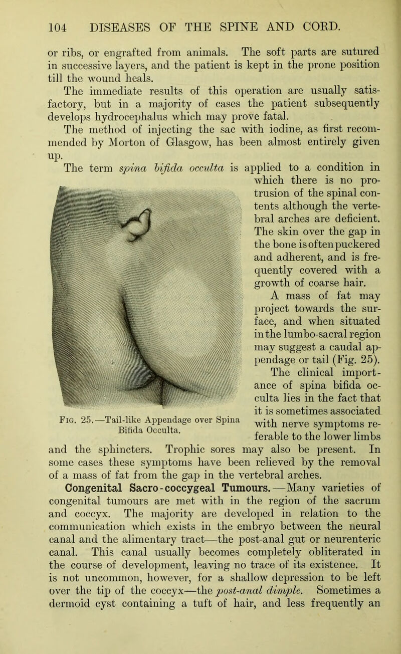 or ribs, or engrafted from animals. The soft parts are sutured in successive layers, and the patient is kept in the prone position till the wound heals. The immediate results of this operation are usually satis- factory, but in a majority of cases the patient subsequently develops hydrocephalus which may prove fatal. The method of injecting the sac with iodine, as first recom- mended by Morton of Glasgow, has been almost entirely given up. The term spina bifida occulta is applied to a condition in which there is no pro- trusion of the spinal con- tents although the verte- bral arches are deficient. The skin over the gap in the bone is often puckered and adherent, and is fre- quently covered with a growth of coarse hair. A mass of fat may project towards the sur- face, and when situated in the lumbo-sacral region may suggest a caudal ap- pendage or tail (Fig. 25). The clinical import- ance of spina bifida oc- culta lies in the fact that it is sometimes associated with nerve symptoms re- ferable to the lower limbs and the sphincters. Trophic sores may also be present. In some cases these symptoms have been relieved by the removal of a mass of fat from the gap in the vertebral arches. Congenital Sacro - coccygeal Tumours.—Many varieties of congenital tumours are met with in the region of the sacrum and coccyx. The majority are developed in relation to the communication which exists in the embryo between the neural canal and the alimentary tract—the post-anal gut or neurenteric canal. This canal usually becomes completely obliterated in the course of development, leaving no trace of its existence. It is not uncommon, however, for a shallow depression to be left over the tip of the coccyx—the post-anal dimple. Sometimes a dermoid cyst containing a tuft of hair, and less frequently an Fig. 25.—Tail-like Appendage over Spina Bilida Occulta.