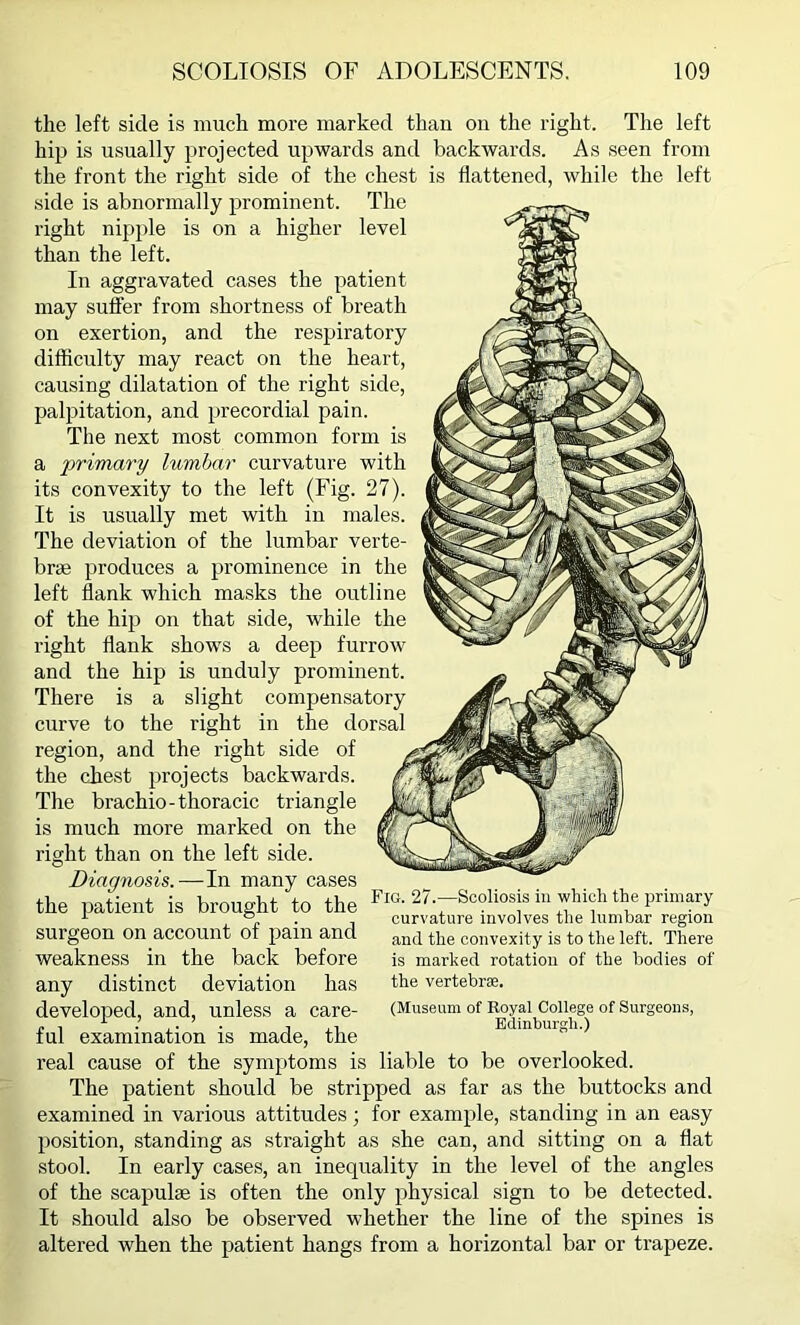 the left side is much more marked than on the right. The left hip is usually projected upwards and backwards. As seen from the front the right side of the chest is flattened, while the left side is abnormally prominent. The right nipple is on a higher level than the left. In aggravated cases the patient may suffer from shortness of breath on exertion, and the respiratory difficulty may react on the heart, causing dilatation of the right side, palpitation, and precordial pain. The next most common form is a 'primary lumbar curvature with its convexity to the left (Fig. 27). It is usually met with in males. The deviation of the lumbar verte- brae produces a prominence in the left flank which masks the outline of the hip on that side, while the right flank shows a deep furrow and the hip is unduly prominent. There is a slight compensatory curve to the right in the dorsal region, and the right side of the chest projects backwards. The brachio-thoracic triangle is much more marked on the right than on the left side. Fig. 27.—Scoliosis in which the primary curvature involves the lumbar region and the convexity is to the left. There is marked rotation of the bodies of the vertebrae. (Museum of Royal College of Surgeons, Edinburgh.) Diagnosis.—In many cases the patient is brought to the surgeon on account of pain and weakness in the back before any distinct deviation has developed, and, unless a care- ful examination is made, the real cause of the symptoms is liable to be overlooked. The patient should be stripped as far as the buttocks and examined in various attitudes; for example, standing in an easy position, standing as straight as she can, and sitting on a flat stool. In early cases, an inequality in the level of the angles of the scapula; is often the only physical sign to be detected. It should also be observed whether the line of the spines is altered when the patient hangs from a horizontal bar or trapeze.