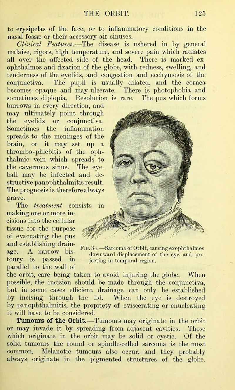 to erysipelas of the face, or to inflammatory conditions in the nasal fossae or their accessory air sinuses. Clinical Features.—The disease is ushered in by general malaise, rigors, high temperature, and severe pain which radiates all over the affected side of the head. There is marked ex- ophthalmos and fixation of the globe, with redness, swelling, and tenderness of the eyelids, and congestion and ecchymosis of the conjunctiva. The pupil is usually dilated, and the cornea becomes opaque and may ulcerate. There is photophobia and sometimes diplopia. Resolution is rare. The pus which forms burrows in every direction, and may ultimately point through the eyelids or conjunctiva. Sometimes the inflammation spreads to the meninges of the brain, or it may set up a thrombo-phlebitis of the oph- thalmic vein which spreads to the cavernous sinus. The eye- ball may be infected and de- structive panophthalmitis result. The prognosis is therefore always grave. The treatment consists making one or more in- cisions into the cellular tissue for the purpose of evacuating the pus and establishing drain- age. A narrow bis- toury is passed in parallel to the wall of the orbit, care being taken to avoid injuring the globe. When possible, the incision should be made through the conjunctiva, but in some cases efficient drainage can only be established by incising through the lid. When the eye is destroyed by panophthalmitis, the propriety of eviscerating or enucleating it will have to be considered. Tumours of the Orbit.—Tumours may originate in the orbit or may invade it by spreading from adjacent cavities. Those which originate in the orbit may be solid or cystic. Of the solid tumours the round or spindle-celled sarcoma is the most common. Melanotic tumours also occur, and they probably Fig. 34.—Sarcoma of Orbit, causing exophthalmos downward displacement of the eye, and pro- jecting in temporal region. always in the pigmented structures of the globe.