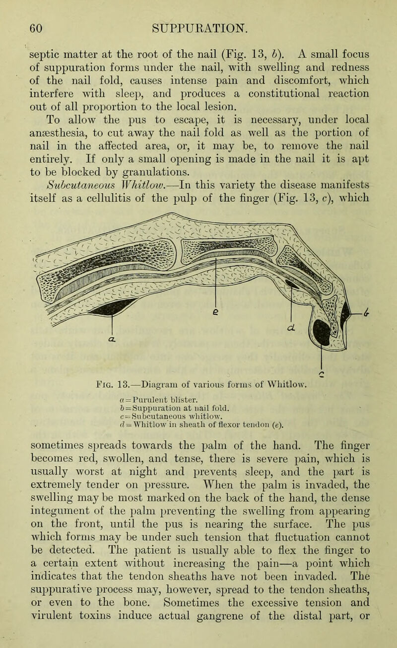 septic matter at the root of the nail (Fig. 13, b). A small focus of suppuration forms under the nail, with swelling and redness of the nail fold, causes intense pain and discomfort, which interfere with sleep, and produces a constitutional reaction out of all proportion to the local lesion. To allow the pus to escape, it is necessary, under local anaesthesia, to cut away the nail fold as well as the portion of nail in the affected area, or, it may be, to remove the nail entirely. If only a small opening is made in the nail it is apt to be blocked by granulations. Subcutaneous Whitlow.—In this variety the disease manifests itself as a cellulitis of the pulp of the finger (Fig. 13, c), which Fig. 13.—Diagram of various forms of Whitlow. a = Purulent blister. Z) = Suppuration at nail fold. c=Sul)cutaneous wliitlow. (? = Whitlow in sheath of flexor tendon (e). sometimes spreads towards the palm of the hand. The finger becomes red, swollen, and tense, there is severe pain, which is usually worst at night and prevents sleep, and the part is extremely tender on pressure. When the palm is invaded, the swelling may be most marked on the back of the hand, the dense integument of the palm preventing the swelling from appearing on the front, until the pus is nearing the surface. The pus which forms may be under such tension that fiuctua,tion cannot be detected. The patient is usually able to flex the finger to a certain extent without increasing the pain—a j^oint which indicates that the tendon sheaths have not been invaded. The suppurative process may, however, sjiread to the tendon sheaths, or even to the bone. Sometimes the excessive tension and virulent toxins induce actual gangrene of the distal part, or