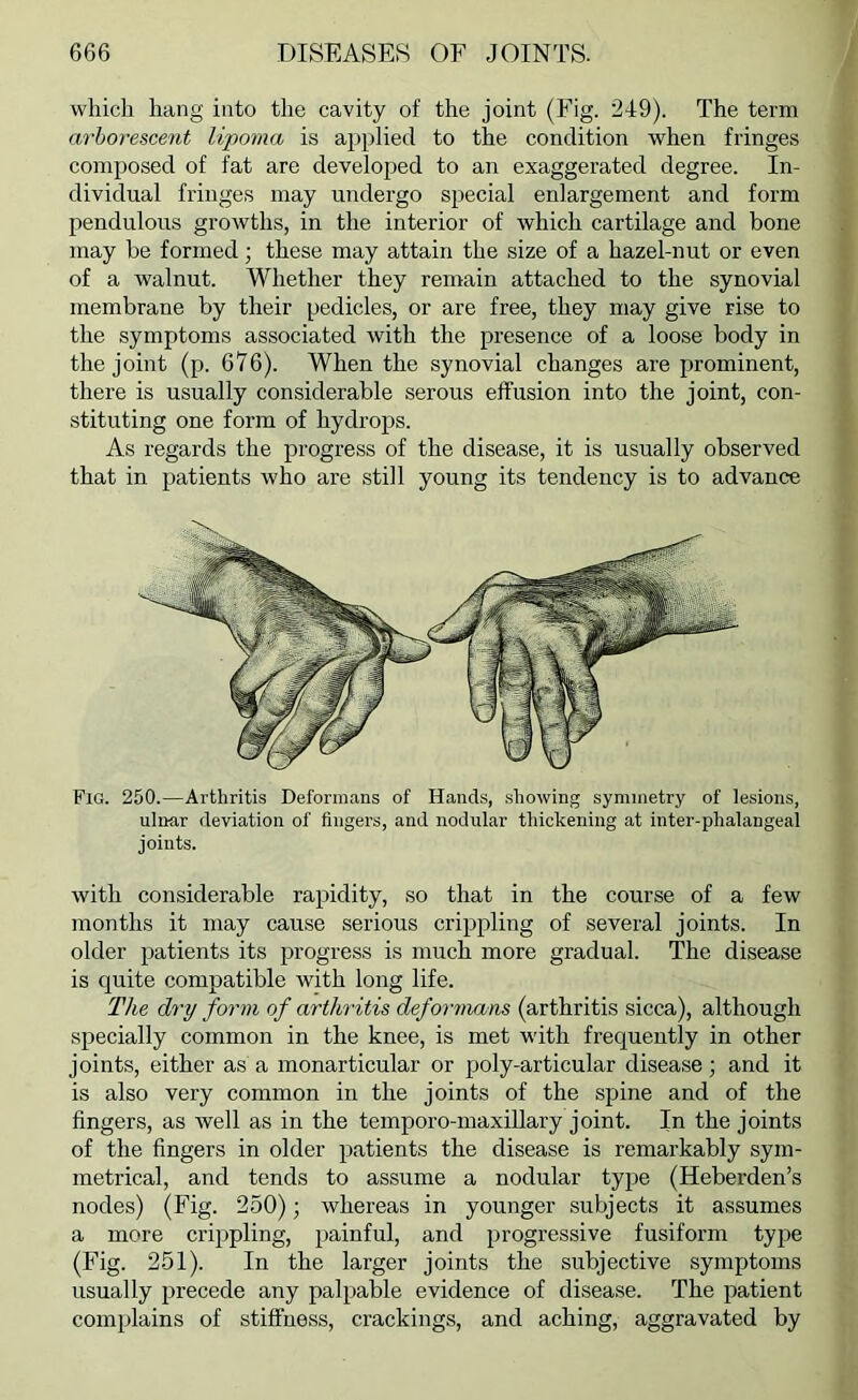 which hang into the cavity of the joint (Fig. 249). The term arborescent lipoma is applied to the condition when fringes composed of fat are developed to an exaggerated degree. In- dividual fringes may undergo special enlargement and form pendulous growths, in the interior of which cartilage and bone may be formed; these may attain the size of a hazel-nut or even of a walnut. Whether they remain attached to the synovial membrane by their pedicles, or are free, they may give rise to the symptoms associated with the presence of a loose body in the joint (p. 676). When the synovial changes are prominent, there is usually considerable serous effusion into the joint, con- stituting one form of hydrops. As regards the progress of the disease, it is usually observed that in patients who are still young its tendency is to advance Fig. 250.—Arthritis Deformans of Hands, showing symmetry of lesions, ulnar deviation of fingers, and nodular thickening at inter-phalangeal joints. with considerable rapidity, so that in the course of a few months it may cause serious crippling of several joints. In older jratients its progress is much more gradual. The disease is quite compatible with long life. The dry form of arthritis deformans (arthritis sicca), although specially common in the knee, is met with frequently in other joints, either as a monarticular or poly-articular disease; and it is also very common in the joints of the spine and of the fingers, as Avell as in the tempero-maxillary joint. In the joints of the fingers in older patients the disease is remarkably sym- metrical, and tends to assume a nodular tyj^e (Heberden’s nodes) (Fig. 2.50); whereas in younger subjects it assumes a more crijjpling, painful, and progressive fusiform type (Fig. 251). In the larger joints the subjective symptoms usually precede any palpable evidence of disease. The patient complains of stiffness, crackings, and aching, aggravated by