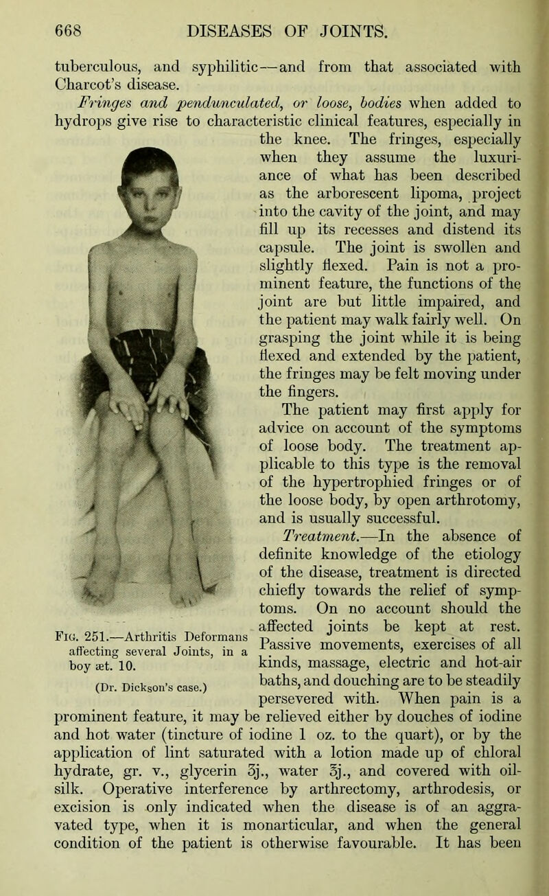 tuberculous, and syphilitic—and from that associated with Charcot’s disease. Fringes and pendunculated, or loose, bodies when added to hydrops give rise to characteristic clinical features, especially in the knee. The fringes, especially when they assume the luxuri- ance of what has been described as the arborescent lipoma, project into the cavity of the joint, and may fill up its recesses and distend its capsule. The joint is swollen and slightly flexed. Pain is not a pro- minent feature, the functions of the joint are but little impaired, and the patient may walk fairly well. On grasping the joint while it is being flexed and extended by the patient, the fringes may be felt moving under the fingers. The patient may first apply for advice on account of the symptoms of loose body. The treatment ap- plicable to this type is the removal of the hypertrophied fringes or of the loose body, by open arthrotomy, and is usually successful. Treatment.—In the absence of definite knowledge of the etiology of the disease, treatment is directed chiefly towards the relief of symp- toms. On no account should the affected joints be kept at rest. Passive movements, exercises of all kinds, massage, electric and hot-air baths, and douching are to be steadily persevered with. When pain is a prominent feature, it may be relieved either by douches of iodine and hot water (tincture of iodine I oz. to the quart), or by the application of lint saturated with a lotion made up of chloral hydrate, gr. v., glycerin 5j., water 5j., and covered with oil- silk. Operative interference by arthrectomy, arthrodesis, or excision is only indicated when the disease is of an aggra- vated type, when it is monarticular, and when the general condition of the patient is otherwise favourable. It has been I Fig. 251.—Arthritis Deformans affecting several Joints, in a boy set. 10. (Dr. Dickson’s case.)