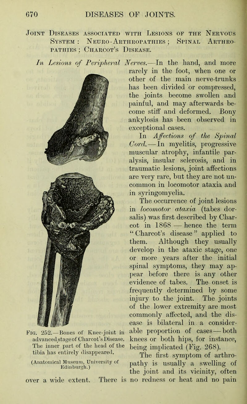 Joint Diseases associated with Lesions of the Nervous System : Neuro-Arthropathies ; Spinal Arthro- pathies : Charcot’s Disease. In Lesions of Peripheral Nerves.—In the hand, and more Fig. 252. — Bones of Knee-joint in advanoedstageof Charcot’s Disease. The inner part of the head of the tibia has entirely disappeared. (Aiiatoniical Museum, University of Edinburgh.) over a wide extent. There is rarely in the foot, when one or other of the main nerve-trunks has been divided or compressed, the joints become swollen and painful, and may afterwards be- come stiff and deformed. Bony ankylosis has been observed in exceptional cases. In Affections of the Spinal (lord. — In myelitis, progressive muscular atrophy, infantile par- alysis, insular sclerosis, and in traumatic lesions, joint affections are very rare, but they are not un- common in locomotor ataxia and in syringomyelia. The occurrence of joint lesions in locomotor ataxia (tabes dor- salis) was first described by Char- cot in 1868 — hence the term “ Charcot’s disease ” applied to them. Although they usually develop in the ataxic stage, one or more years after the initial spinal symptoms, they may ap- jiear before there is any other evidence of tabes. The onset is frequently determined by some injury to the joint. The joints of the lower extremity are most commonly affected, and the dis- ease is bilateral in. a consider- able proportion of cases—both knees or both hips, for instance, being implicated (Eig. 268). The first symptom of arthro- pathy is usually a swelling of the joint and its vicinity, often no redness or heat and no pain