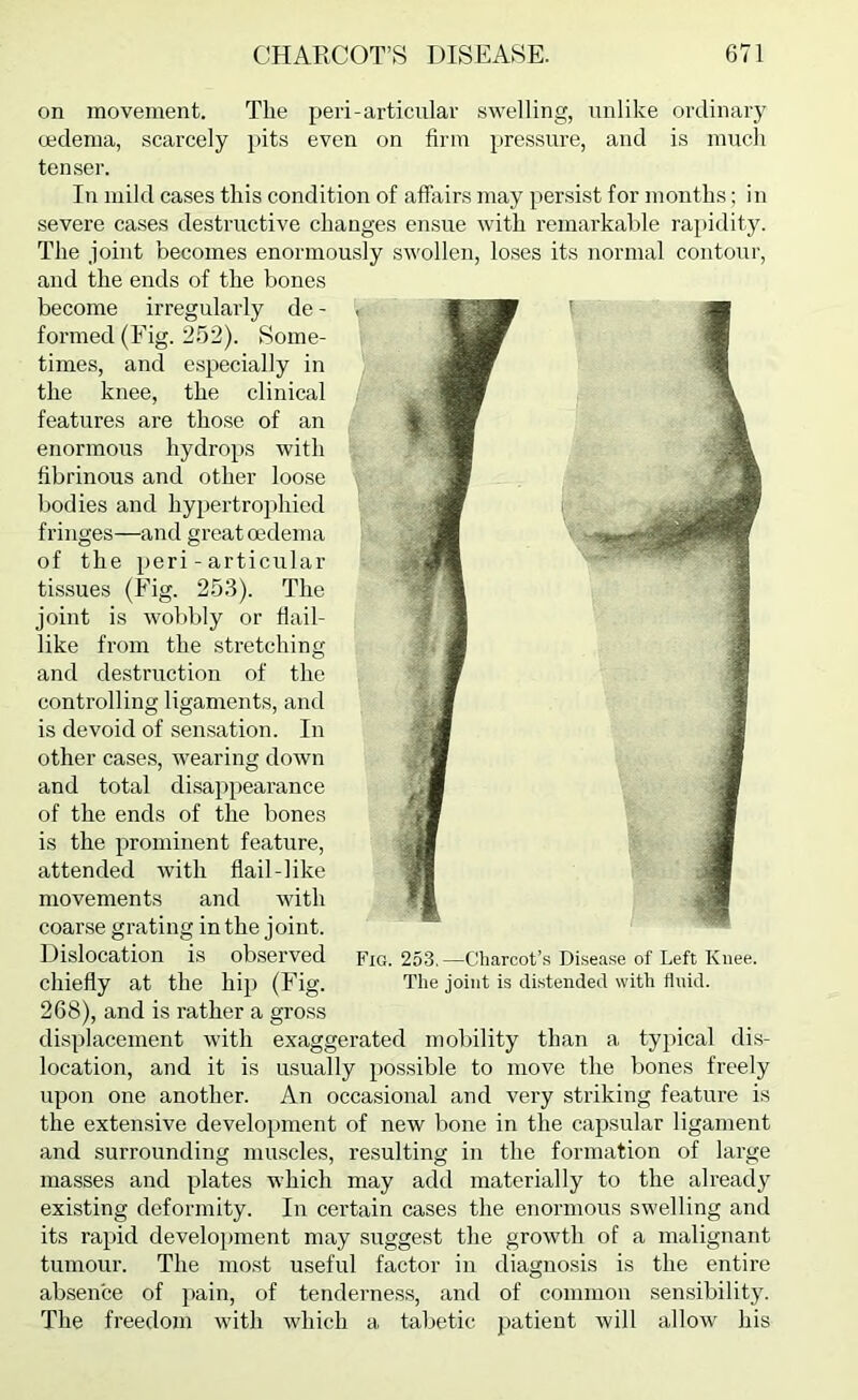 on movement. The peri-articular swelling, unlike ordinary oedema, scarcely pits even on firm pressure, and is much tenser. In mild cases this condition of affirirs may persist for months; in severe cases destructive changes ensue with remarkable rapidity. The joint becomes enormously .swollen, loses its normal contour, and the ends of the bones become irregularly de - formed (Fig. 252). Some- times, and especially in the knee, the clinical features are those of an enormous hydrops with fibrinous and other loose bodies and hypertrophied fringes—and great oedema of the peri - articular tissues (Fig. 253). The joint is wobbly or flail- like from the stretching and destruction of the controlling ligaments, and is devoid of sen.sation. In other case.s, wearing down and total disappearance of the ends of the bones is the prominent feature, attended with flail-like movements and with coarse grating in the joint. Dislocation is observed chiefly at the hip (Fig. 268), and is rather a gross displacement with exaggerated mobility than a typical dis- location, and it is usually pos.sible to move the bones freely upon one another. An occasional and very striking feature is the extensive development of new bone in the capsular ligament and surrounding mu.scles, resulting in the formation of large masses and plates which may add materially to the already existing deformity. In certain cases the enormous swelling and its ra})id development may suggest the growth of a malignant tumour. The most useful factor in diagnosis is the entire absence of jrain, of tenderness, and of common sensibility. The freedom with which a tabetic patient will allow his Fig. 253.—Charcotts Disease of Left Knee. The joint is distended with fluid.