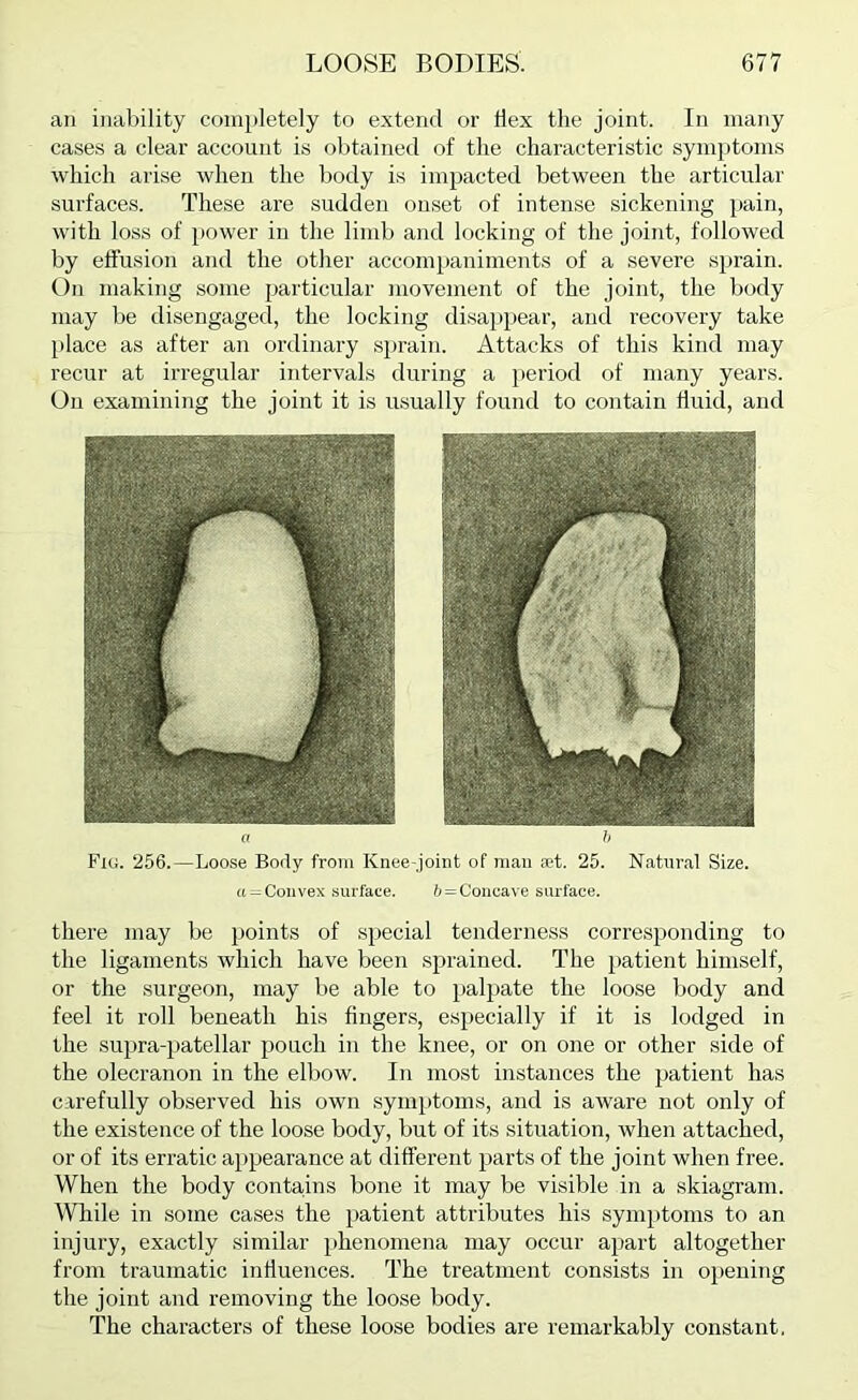 ail inability completely to extend or Hex the joint. In many cases a clear account is obtained of the characteristic syniiitoms which arise when the body is impacted between the articular surfaces. These are sudden onset of intense sickening pain, with loss of iiower in the limb and locking of the joint, followed by etfusion and the other accompaniments of a severe si>rain. On making some particular movement of the joint, the body may be disengaged, the locking disappear, and recovery take l>lace as after an ordinary sprain. Attacks of this kind may recur at irregular intervals during a jieriod of many years. On examining the joint it is usually found to contain fluid, and o h Fig. 256.—Loose Body from Knee-joint of man let. 25. Natural Size, a = Convex surface. /> = Concave surface. there may be points of special tenderness corresponding to the ligaments which have been sprained. The patient himself, or the surgeon, may be able to palpate the loose body and feel it roll beneath his fingers, especially if it is lodged in the supra-patellar pouch in the knee, or on one or other side of the olecranon in the elbow. In most instances the patient has carefully observed his own symptoms, and is aware not only of the existence of the loose body, but of its situation, when attached, or of its erratic appearance at different parts of the joint when free. When the body conta,ins bone it may be visible in a skiagram. AVIiile in some cases the jiatient attributes his symptoms to an injury, exactly similar phenomena may occur apart altogether from traumatic influences. The treatment consists in oj)ening the joint and removing the loose body. The characters of these loose bodies are remarkably constant.