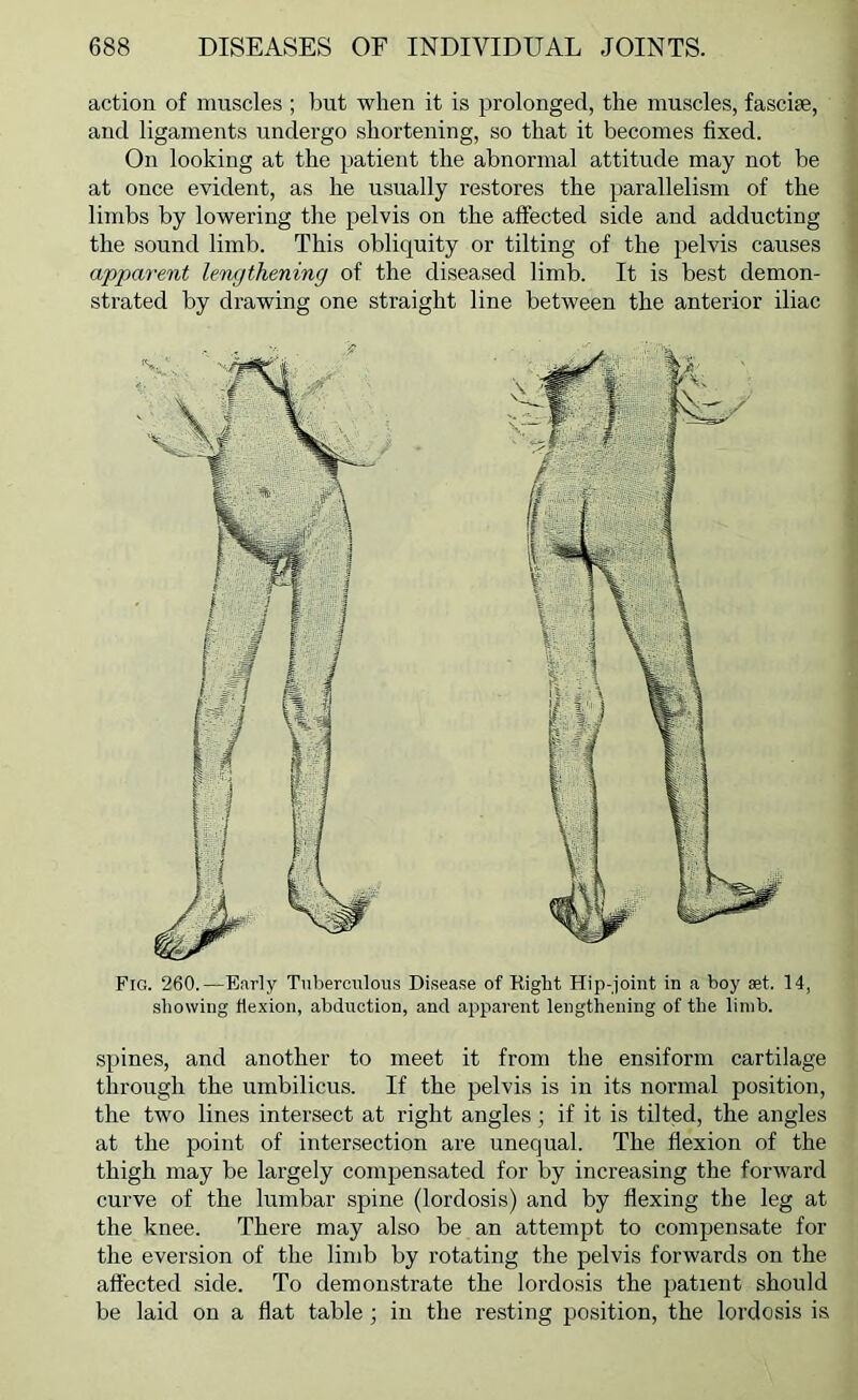 Fig. 260.—Early Tuberculous Disease of Right Hip-joint in a boy set. 14, showing flexion, abduction, and apparent lengthening of the limb. spines, and another to meet it from the ensiform cartilage through the umbilicus. If the pelvis is in its normal position, the two lines intersect at right angles; if it is tilted, the angles at the point of intersection are unequal. The flexion of the thigh may be largely compensated for by increasing the forward curve of the lumbar spine (lordosis) and by flexing the leg at the knee. There may also be an attempt to compensate for the eversion of the limb by rotating the pelvis forwards on the affected side. To demonstrate the lordosis the patient should be laid on a flat table; in the resting position, the lordosis is action of muscles ; but when it is prolonged, the muscles, fascise, and ligaments undergo shortening, so that it becomes fixed. On looking at the patient the abnormal attitude may not be at once evident, as he usually restores the parallelism of the limbs by lowering the pelvis on the affected side and adducting the sound limb. This obliquity or tilting of the pelvis causes apparent lengthening of the diseased limb. It is best demon- strated by drawing one straight line between the anterior iliac