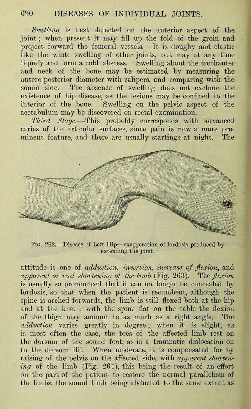 Swelling is best detected on the anterior aspect of the joint; when present it may fill up the fold of the groin and project forward the femoral vessels. It is doughy and elastic like the white swelling of other joints, but may at any time liquefy and form a cold abscess. Swelling about the trochanter and neck of the bone may be estimated by measuring the antero-posterior diameter with calipers, and comparing with the sound side. The absence of swelling does not exclude the existence of hiji disease, as the lesions may be confined to the interior of the bone. Swelling on the pelvic aspect of the acetabulum may be discovered on rectal examination. Third Stage.—This probably corresponds with advanced caries of the articular surfaces, since pain is now a more pro- minent feature, and there are usually startings at night. The Fig. 262.—Disease of Left Hip—exaggeration of lordosis produced by extending the joint. attitude is one of adduction, inversion, increase of flexion, and apparent or real shortening of the limb (Fig. 263). The^e^ow is usually so pronounced that it can no longer be concealed by lordosis, so that when the patient is recumbent, although the spine is arched forwards, the limb is still flexed both at the hip and at the knee ; with the spine flat on the table the flexion of the thigh may amount to as much as a right angle. The adduction varies greatly in degree; when it is slight, as is most often the case, the toes of the affected limb rest on the dorsum of the sound foot, as in a traumatic dislocation on to the dorsum ilii. When moderate, it is compensated for by raising of the pelvis on the affected side, with apparent shorten- ing of the limb (Fig. 264), this being the result of an effort on the part of the patient to restore the normal parallelism of the limbs, the sound limb being abducted to the same extent as