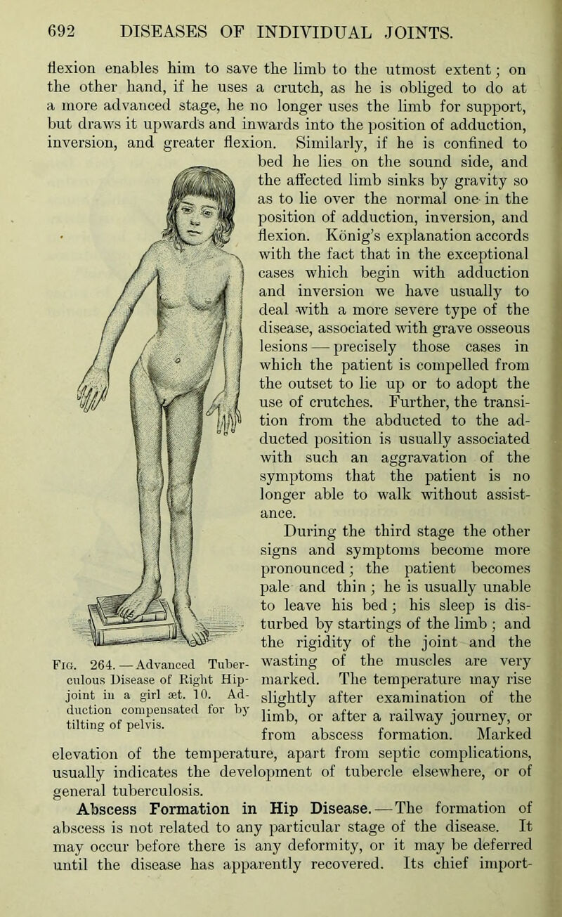 flexion enables him to save the limb to the utmost extent; on the other hand, if he uses a crutch, as he is obliged to do at a more advanced stage, he no longer uses the limb for support, but draws it upwards and inwards into the position of adduction, inversion, and greater flexion. Similarly, if he is confined to bed he lies on the sound side, and the affected limb sinks by gravity so as to lie over the normal one- in the position of adduction, inversion, and flexion. Kdnig’s explanation accords with the fact that in the exceptional cases which begin with adduction and inversion we have usually to deal with a more severe type of the disease, associated with grave osseous lesions — precisely those cases in which the patient is compelled from the outset to lie up or to adopt the use of crutches. Further, the transi- tion from the abducted to the ad- ducted position is usually associated with such an aggravation of the symptoms that the patient is no longer able to walk without assist- ance. During the third stage the other signs and symptoms become more pronounced; the patient becomes pale and thin ; he is usually unable to leave his bed; his sleep is dis- turbed by startings of the limb ; and the rigidity of the joint and the Fig. 264.—Advanced Tuber- wasting of the muscles are very culous Disease of Right Hip- marked. The temperature may rise joint in a girl set. 10. Ad- slightly after examination of the duction compensated for by ^ journey, or 1 uiq o pe VIS. from abscess formation. Marked elevation of the temperature, apart from septic complications, usually indicates the development of tubercle elsewhere, or of general tuberculosis. Abscess Formation in Hip Disease.—The formation of abscess is not related to any particular stage of the disease. It may occur before there is any deformity, or it may be deferred until the disease has apparently recovered. Its chief import-