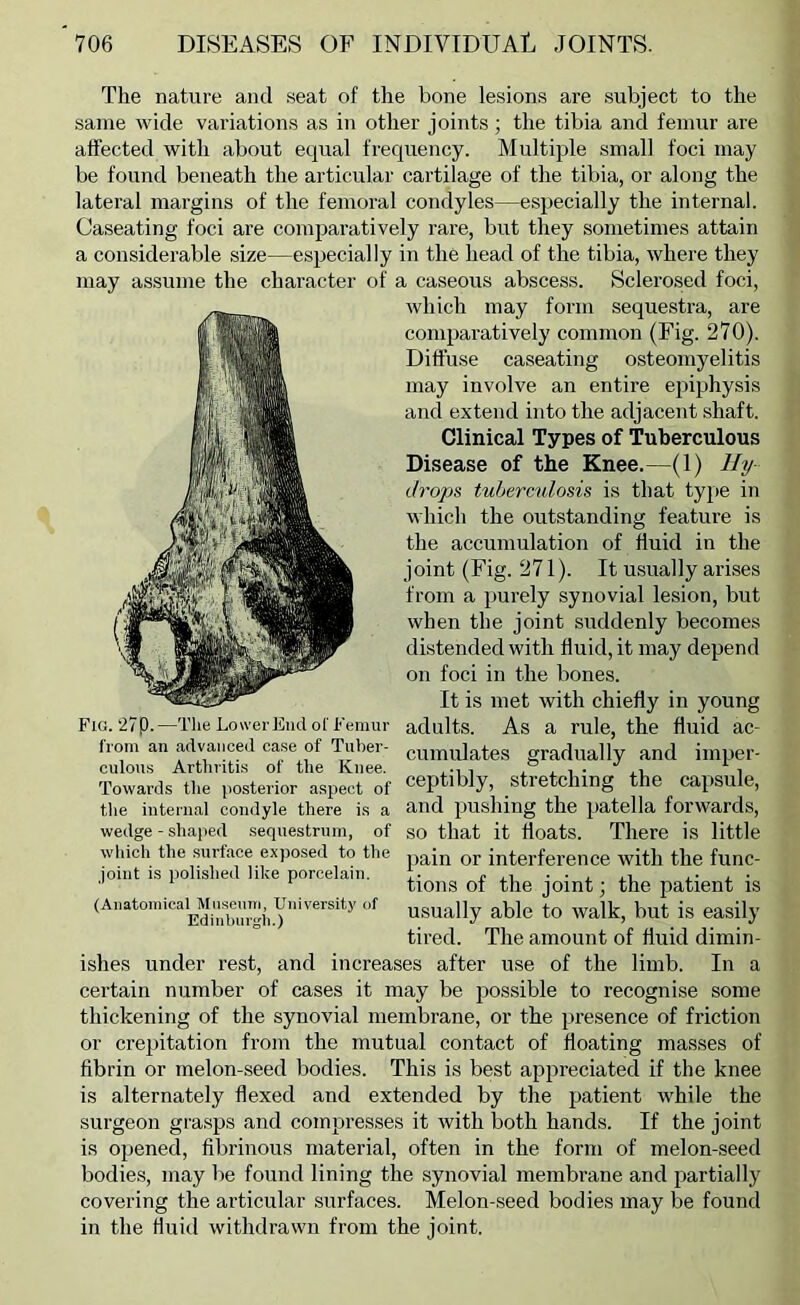 The nature and seat of the bone lesions are subject to the same wide variations as in other joints; the tibia and femur are affected with about equal frequency. Multiple small foci may be found beneath the articular cartilage of the tibia, or along the lateral margins of the femoral condyles—especially the internal. Caseating foci are comparatively rare, but they sometimes attain a considerable size—especially in the head of the tibia, where they may assume the character of a caseous abscess. Sclerosed foci, which may form sequestra, are comparatively common (Fig. 270). Diffuse caseating osteomyelitis may involve an entire epiphysis and extend into the adjacent shaft. Clinical Types of Tuberculous Disease of the Knee.—(1) Hy drops tuberculosis is that type in which the outstanding feature is the accumulation of fluid in the joint (Fig. 271). It usually arises from a purely synovial lesion, but when the joint suddenly becomes distended with fluid, it may depend on foci in the bones. It is met with chiefly in young Fig. 27p.—The Lower End ol'Femur adults. As a rule, the fluid ac- Irom an advanced case of Tuber- cumulates gradually and imper- culous Arthriti.s of the Knee. .i • ,i i Towards the posterior a.spect of ceptibly, stretching the capsule, tlie internal condyle there is a and pushing the patella forwards, wedge - shaped sequestrum, of so that it floats. There is little which the surface exposed to the qj. interference with the func- ioiiit IS pohslieu like porcelain. . .1 j.* j. • ■’ ^ ^ tions 01 the joint; the patient is (Anatomicai^Mn^^^^^^^^ of ^ble to Walk, but is easily tired. The amount of fluid dimin- ishes under rest, and increases after use of the limb. In a certain number of cases it may be possible to recognise some thickening of the synovial membrane, or the presence of friction or crepitation from the mutual contact of floating masses of fibrin or melon-.seed bodies. This is best appreciated if the knee is alternately flexed and extended by the patient while the surgeon grasps and compresses it with both hands. If the joint is opened, fibrinous material, often in the form of melon-seed bodie-s, may be found lining the synovial membrane and partially covering the articular surfaces. Melon-seed bodies may be found in the fluid withdrawn from the joint.