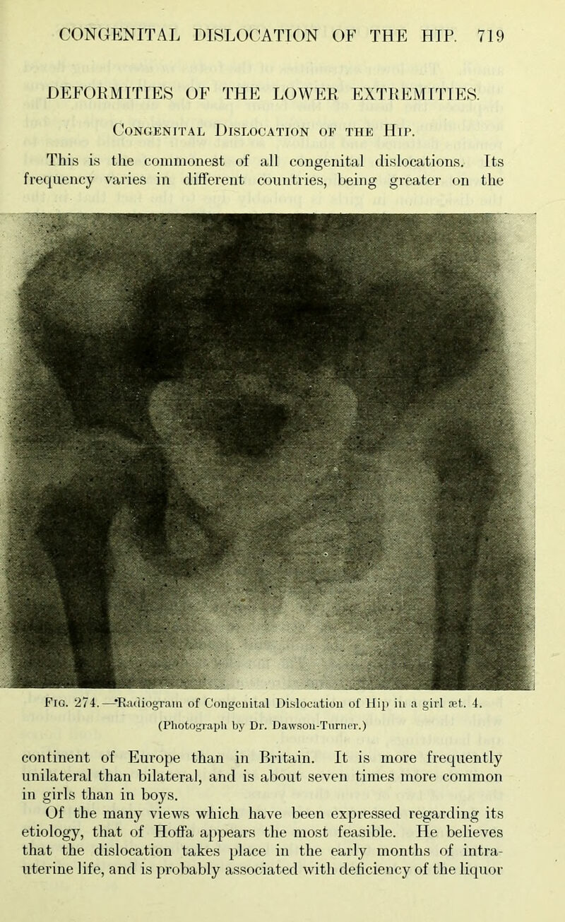 DEFOPMITIES OF THE LOWER EXTREMITIES. Congenital Dislocation of the Hii-. Tliis i.s tlie commonest of all congenital dislocations. Its frequency varies in different countries, being greater on the Fig. 274.—-•Radiograiii of Congenital Dislocation of liip in a girl let. 4. (Photograpli by Dr. Dawson-Turnor.) continent of Europe than in Britain. It is more frequently unilateral than bilateral, and is about seven times more common in girls than in boys. Of the many views which have been expressed regarding its etiology, that of Hoffa appears the most feasible. He believes that the dislocation takes place in the early months of intra- uterine life, and is probably associated with deficiency of the liquor