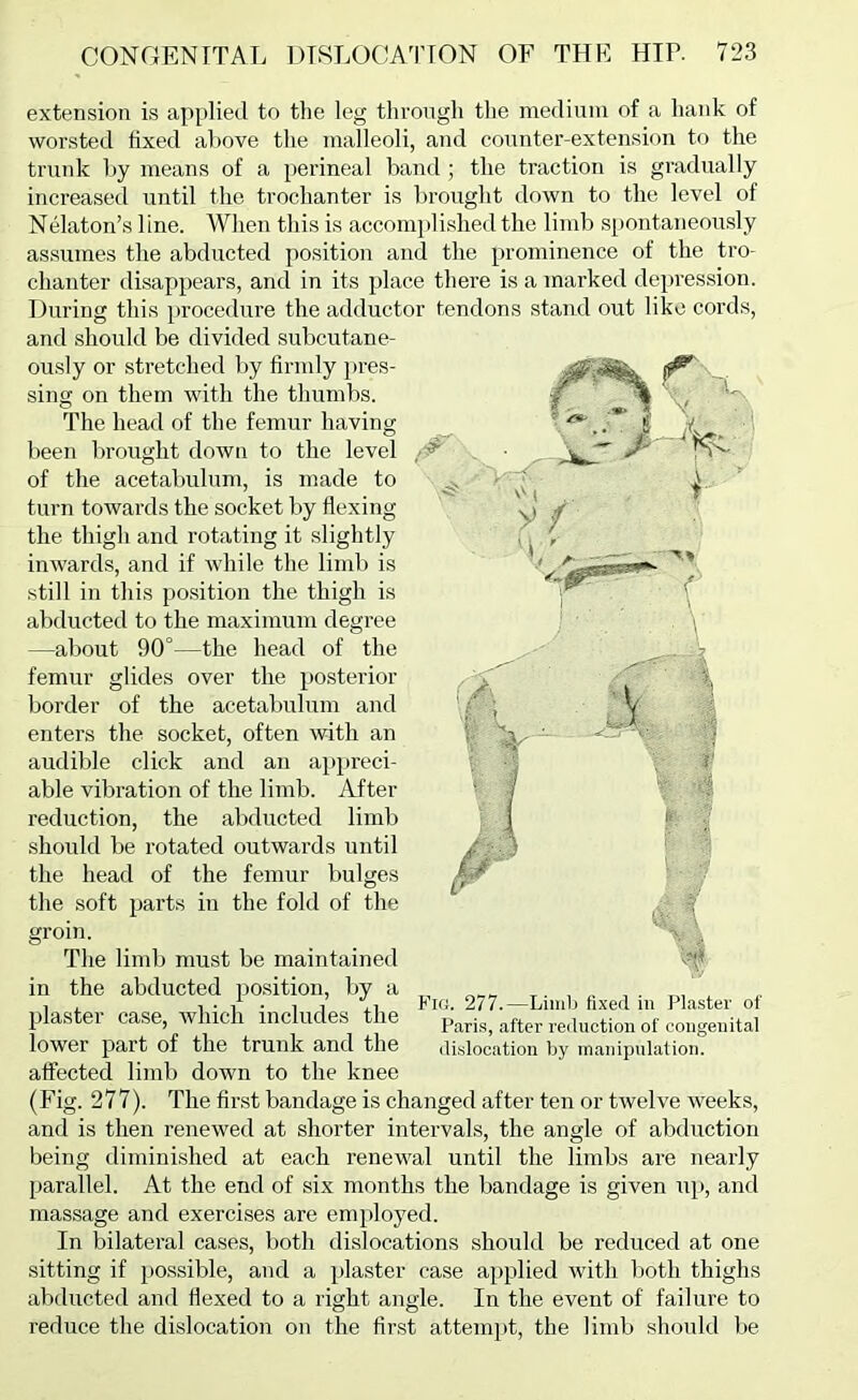 extension is applied to the leg throngli the medinm of a hank of worsted fixed above the malleoli, and counter-extension to the trunk by means of a perineal band; the traction is gradually increased until the trochanter is brought down to the level of Nelaton’s line. When this is accomplished the limb spontaneously assumes the abducted position and the prominence of the tro- chanter disappears, and in its place there is a marked depression. During this procedure the adductor tendons stand out like cords. and should be divided subcutane- ously or stretched by firmly pres- sing on them with the thumbs. The head of the femur having been brought down to the level of the acetabulum, is made to turn towards the socket by flexing the thigh and rotating it slightly inwards, and if while the limb is still in this position the thigh is abducted to the maximum degree —about 90°—the head of the femur glides over the posterior border of the acetabulum and enters the socket, often \vith an audible click and an appreci- able vibration of the limb. After reduction, the abducted limb should be rotated outwards until the head of the femur bulges the soft parts in the fold of the groin. The lindj must be maintained in the abducted position, by a Fig. 277.—Limb fixed in Plaster of Paris, after re<Uictioii of congenital dislocation by inanipnlation. plaster case, which includes the lower part of the trunk and the affected limb down to the knee (Fig. 277). The first bandage is changed after ten or twelve weeks, and is then renewed at shorter intervals, the angle of abduction being diminished at each renewal until the limbs are nearly parallel. At the end of six months the bandage is given up, and massage and exercises are employed. In bilateral cases, both dislocations should be reduced at one sitting if possible, and a plaster case applied with both thighs abducted and flexed to a right angle. In the event of failure to reduce the dislocation on the first attempt, the limb should be
