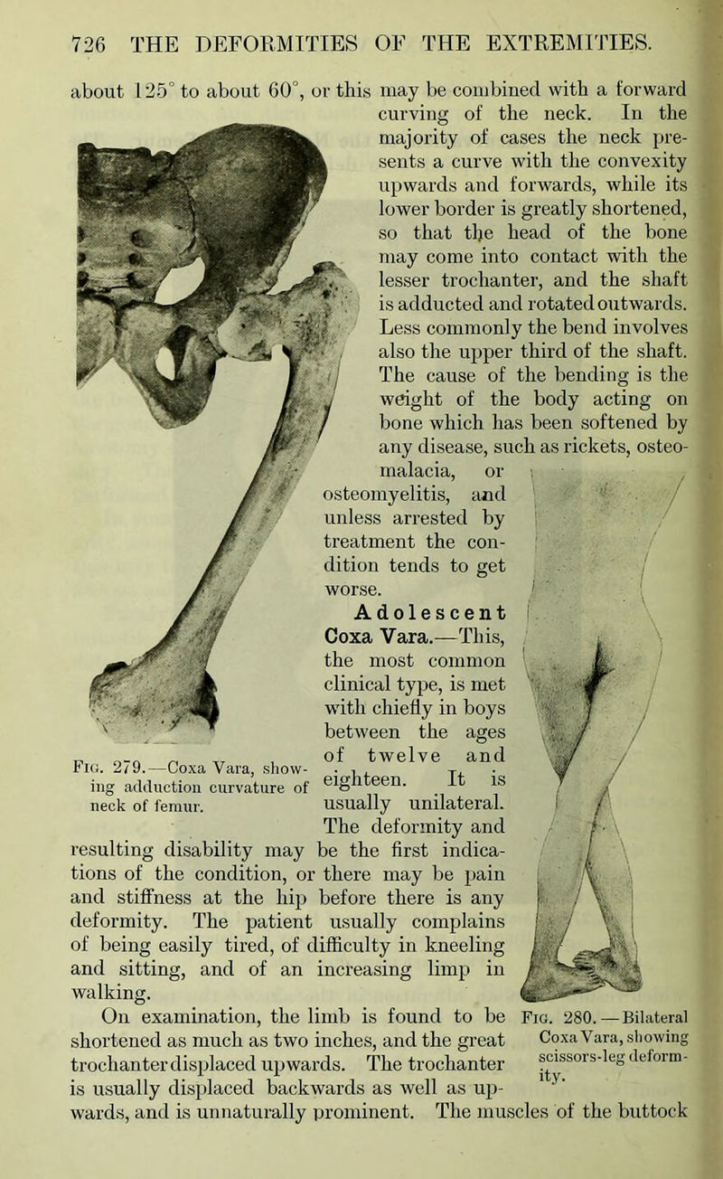 about 125° to about 60°, or this may be combined with a forward curving of the neck. In the majority of cases the neck ju’e- sents a curve with the convexity upwards and forwards, while its lower border is greatly shortened, so that the head of the bone may come into contact with the lesser troclianter, and the shaft is adducted and rotated outwards. Less commonly the bend involves also the upper third of the shaft. The cause of the bending is the weight of the body acting on bone which has been softened by any disease, such as rickets, osteo- malacia, or osteomyelitis, and unless arrested by treatment the con- dition tends to get worse. Adolescent Coxa Vara.—This, the most common clinical type, is met with chiefly in boys between the ages of twelve and eighteen. It is usually unilateral. The deformity and resulting disability may be the first indica- tions of the condition, or there may be pain and stiffness at the hip before there is any deformity. The patient usually complains of being easily tired, of difficulty in kneeling and sitting, and of an increasing limp in walking. Fk;. 279.—Coxa Vara, show- ing adduction curvature of neck of femur. On examination, the limb is found to be Fig. 280.—Bilateral shortened as much as two inches, and the great Coxa Vara, showing trochanter displaced upwards. The trochanter scissors-leg deform- is usually displaced backwards as well as up- wards, and is unnaturally prominent. The muscles of the buttock
