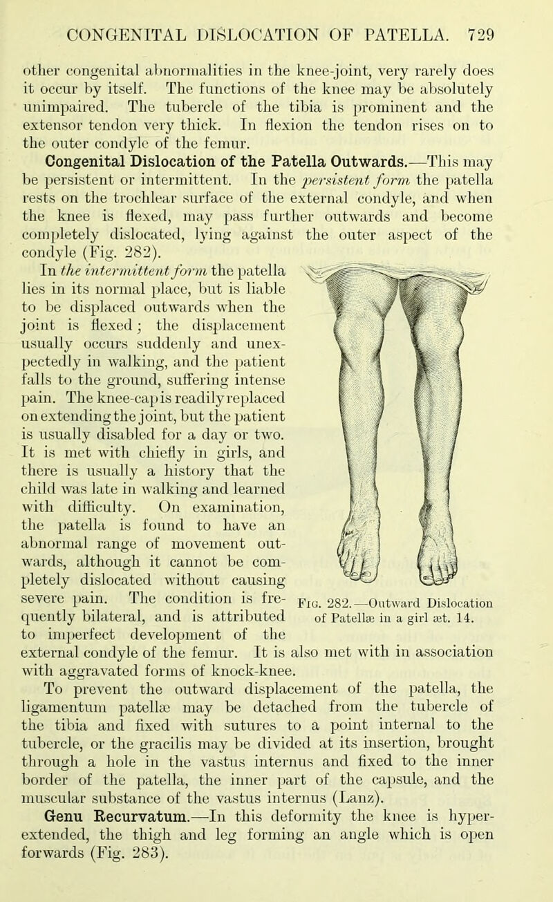 other congenital ahnormalities in the knee-joint, very rarely doe.s it occur by itself. The functions of the knee may be absolutely unimpaired. The tubercle of the tibia is prominent and the extensor tendon very thick. In flexion the tendon rises on to the outer condyle of the femur. Congenital Dislocation of the Patella Outwards.—This may be persistent or intermittent. In the -persistent form the patella rests on the trochlear surface of the external condyle, and when the knee is flexed, may jiass further outwards and become com[)letely dislocated, lying against the outer aspect of the condyle (Fig. 282). In the intermittent form the patella lies in its normal place, but is liable to be displaced outwards when the joint is flexed; the displacement usually occurs suddenly and unex- pectedly ill walking, and the patient falls to the ground, suffering intense jiain. The knee-cap is readily replaced on extending the joint, but the patient is usually disabled for a day or two. It is met with chiefly in girls, and there is usually a history that the child was late in walking and learned with difficulty. On examination, the patella is found to have an abnormal range of movement out- wards, although it cannot be com- pletely dislocated without causing severe pain. The condition is fre- cpiently bilateral, and is attributed to imperfect development of the external condyle of the femur. It is also met with in association with aggravated forms of knock-knee. To prevent the outward displacement of the patella, the ligamentum patellm may be detached from the tubercle of the tibia and fixed with sutures to a point internal to the tubercle, or the gracilis may be divided at its insertion, brought through a hole in the vastus iuternus and fixed to the inner border of the patella, the inner i>art of the capsule, and the muscular substance of the vastus internus (Lanz). Genu Recurvatum.—In this deformity the knee is hyper- extended, the thigh and leg forming an angle which is open forwards (Fig. 283). Fiu. 282.—Outward Dislocation of Patellae iii a girl aet. 14.