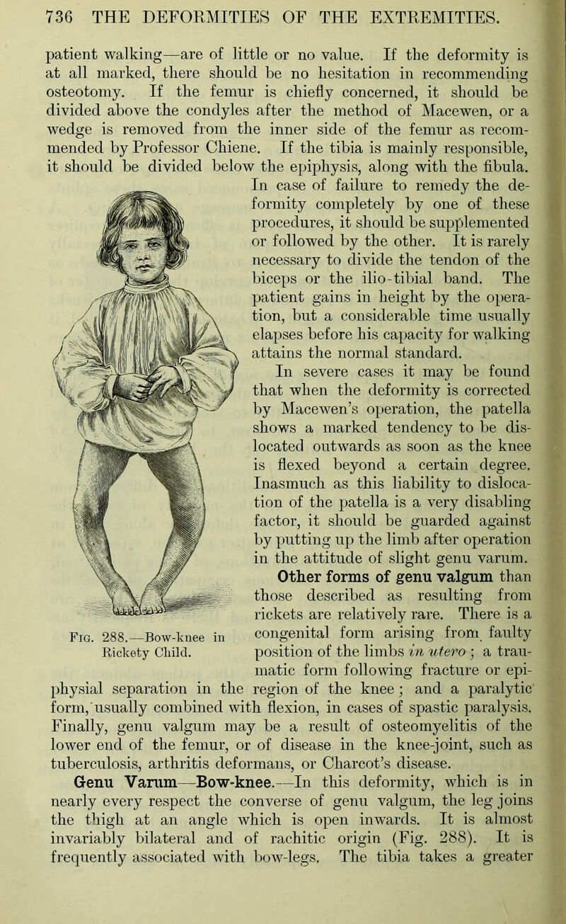 patient walking—are of little or no value. If the deformity is at all marked, tliere should be no hesitation in recommending osteotomy. If the femur is chiefly concerned, it should be divided above the condyles after the method of Macewen, or a wedge is removed from the inner side of the femur as recom- mended by Professor Chiene. If the tibia is mainly responsible, it should be divided below the epiphysis, along with the fibula. In case of failure to remedy the de- formity completely by one of these procedures, it should be supplemented or followed by the other. It is rarely necessary to divide the tendon of the biceps or the ilio-tibial band. The patient gains in height by the opera- tion, but a considerable time usually elapses before his capacity for walking attains the normal standard. In severe cases it may be found that when the deformity is corrected by Macewen’s operation, the patella shows a marked tendency to be dis- located outwards as soon as the knee is flexed beyond a certain degree. Inasmuch as this liability to disloca- tion of the patella is a very disabling factor, it should be guarded against by putting up the limb after operation in the attitude of slight genu varum. Other forms of genu valgum than those described as resulting from rickets are relatively rare. There is a congenital form arising from faulty position of the limbs in v.tero ; a trau- matic form following fracture or epi- physial separation in the region of the knee; and a paralytic form,'usually combined with flexion, in cases of spastic jraralysis. Finally, genu valgum may be a result of osteomyelitis of the lower end of the femur, or of disease in the knee-joint, such as tuberculosis, arthritis deformans, or Charcot’s disease. Genu Varum—Bow-knee.—In this deformity, which is in nearly every respect the converse of genu valgum, the leg joins the thigh at an angle which is open inwards. It is almost invariably bilateral and of rachitic origin (Fig. 288). It is frequently associated with bow-legs. The tibia takes a greater Fig. 288.—Bow-knee in Rickety Child.