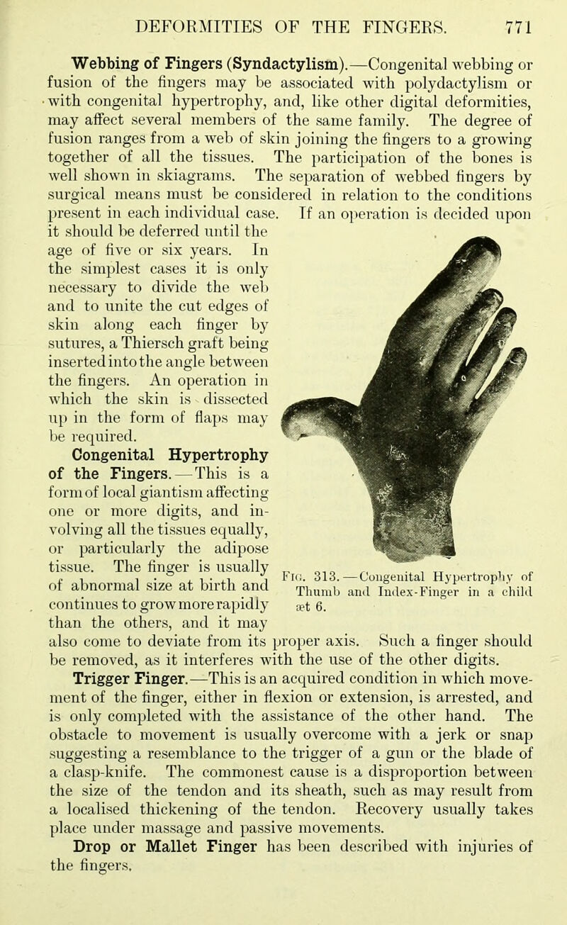 Webbing of Fingers (Syndactylism).—Congenital webbing or fusion of the fingers may be associated with poly dactyl ism or • with congenital hypertrophy, and, like other digital deformities, may affect several members of the same family. The degree of fusion ranges from a web of skin joining the fingers to a growing together of all the tissues. The participation of the bones is well shown in skiagrams. The separation of webbed fingers by surgical means must be considered in relation to the conditions present in each individual case. If an ojieration is decided upon it should be deferred until the age of live or six years. In the simplest cases it is only necessary to divide the web and to unite the cut edges of skin along each finger by sutures, a Thiersch graft being inserted into the angle between the fingers. An operation in which the skin is dissected up in the form of flaps may be required. Congenital Hypertrophy of the Fingers.—This is a form of local giantism affecting one or more digits, and in- volving all the tissues equally, or particularly the adipose tissue. The Anger is usually of abnormal size at birth and continues to grow more rapidly than the others, and it may also come to deviate from its proper axis be removed, as it interferes with the use of the other digits Trigger Finger.—This is an acquired condition in which move- ment of the finger, either in flexion or extension, is arrested, and is only completed with the assistance of the other hand. The obstacle to movement is usually overcome with a jerk or snap suggesting a resemblance to the trigger of a gun or the blade of a clasp-knife. The commonest cause is a disproportion between the size of the tendon and its sheath, such as may result from a localised thickening of the tendon. Recovery usually takes place under massage and passive movements. Drop or Mallet Finger has been described with injuries of the fingers. Frc. 313.—Congenital Hypertrop'iy of Thumb and Index-Finger in a child set 6. Such a finger should