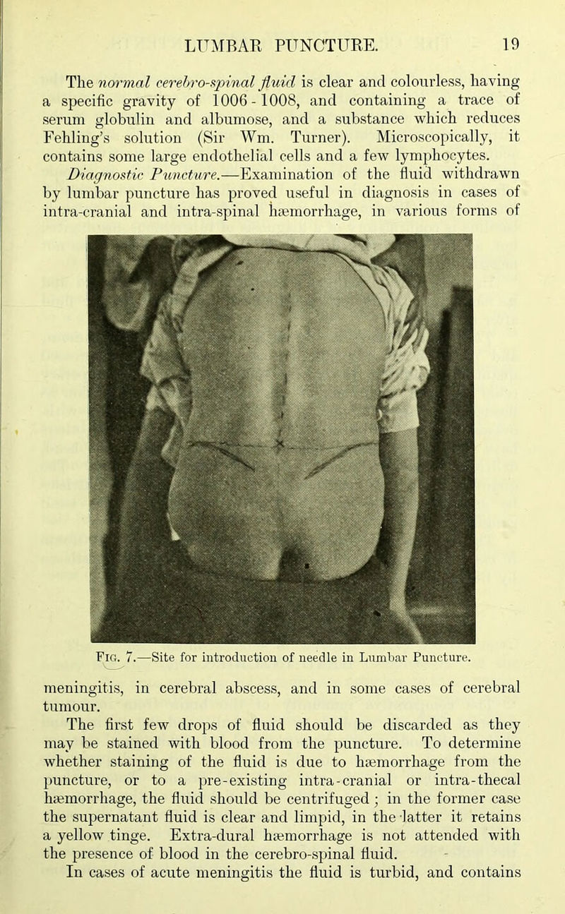 The normal cerebrospinal fluid is clear and colourless, having a specific gravity of 1006-1008, and containing a trace of serum globulin and albumose, and a substance which reduces Fehling’s solution (Sir Wm. Turner). Microscopically, it contains some large endothelial cells and a few lymphocytes. Diagnostic Puncture.—Examination of the fluid withdrawn by lumbar puncture has proved useful in diagnosis in cases of intra-cranial and intra-spinal haemorrhage, in various forms of Fir. 7.—Site for introduction of needle in Lumbar Puncture. meningitis, in cerebral abscess, and in some cases of cerebral tumour. The first few drops of fluid should be discarded as they may be stained with blood from the puncture. To determine whether staining of the fluid is due to luemorrhage from the puncture, or to a pre-existing intra-cranial or intra-thecal haemorrhage, the fluid should be centrifuged; in the former case the supernatant fluid is clear and limpid, in the latter it retains a yellow tinge. Extra-dural haemorrhage is not attended with the presence of blood in the cerebro-spinal fluid. In cases of acute meningitis the fluid is turbid, and contains