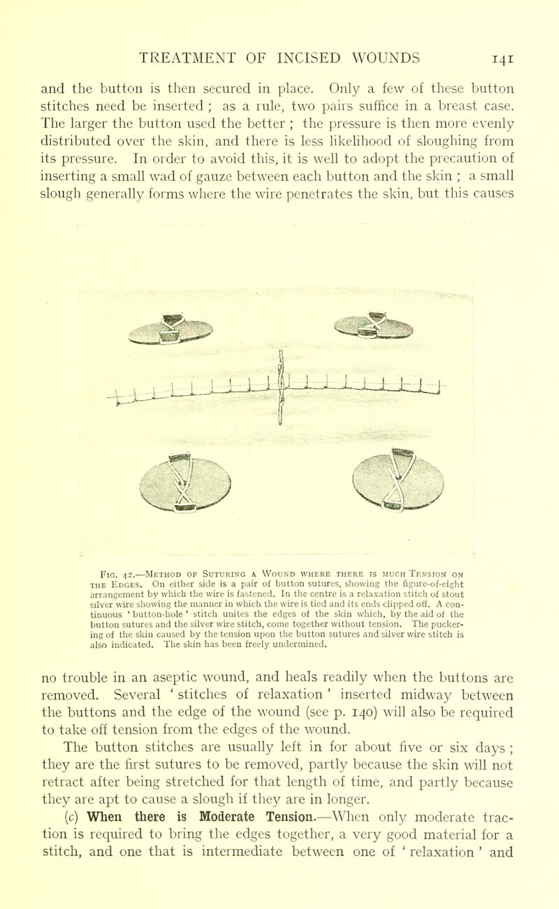 and the button is then secured in place. Only a few of these button stitches need be inserted ; as a rule, two pairs suffice in a breast case. The larger the button used the better ; the pressure is then more evenly distributed over the skin, and there is less likelihood of sloughing from its pressure. In order to avoid this, it is well to adopt the precaution of inserting a small wad of gauze between each button and the skin ; a small slough generally forms where the wire penetrates the skin, but this causes Fig. 42.—Method of Suturing a Wound where there is much Tension on THE Edges. On either side is a pair of button sutures, showing the figure-of-eight arrangement by which the wire is fastened. In the centre is a relaxation stitch of stout silver wire showing the manner in which the wire is tied and its ends clipped off. A con- tinuous ' button-hole ' stitch unites the edges of the skin which, by the aid of the button sutures and the silver wire stitch, come together without tension. The pucker- ing of the sldn caused by the tension upon the button sutures and silver wire stitch is also indicated. The skin has been freely undermined. no trouble in an aseptic wound, and heals readily when the buttons are removed. Several ' stitches of relaxation ' inserted midway between the buttons and the edge of the wound (see p. 140) will also be required to take off tension from the edges of the wound. The button stitches are usually left in for about five or six days ; they are the first sutures to be removed, partly because the skin will not retract after being stretched for that length of time, and partly because they are apt to cause a slough if they are in longer. (c) When there is Moderate Tension.—When only moderate trac- tion is required to bring the edges together, a very good material for a stitch, and one that is intermediate between one of ' relaxation ' and