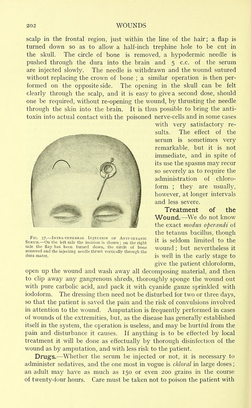 scalp in the frontal region, just within the line of the hair; a flap is turned down so as to allow a half-inch trephine hole to be cut in the skull. The circle of bone is removed, a hypodermic needle is pushed through the dura into the brain and 5 c.c. of the serum are injected slowly. The needle is withdrawn and the wound sutured without replacing the crown of bone ; a similar operation is then per- formed on the opposite side. The opening in the skull can be felt clearly through the scalp, and it is easy to give a second dose, should one be required, without re-opening the wound, by thrusting the needle through the skin into the brain. It is thus possible to bring the anti- toxin into actual contact with the poisoned nerve-cells and in some cases with very satisfactory re- sults. The effect of the serum is sometimes very remarkable, but it is not immediate, and in spite of its use the spasms may recur so severely as to require the administration of chloro- form ; they are usually, however, at longer intervals and less severe. Treatment of the Wound.—We do not know the exact modus operandi of the tetanus bacillus, though it is seldom limited to the wound; but nevertheless it is well in the early stage to give the patient chloroform, open up the wound and wash away all decomposing material, and then to clip away any gangrenous shreds, thoroughly sponge the wound out with pure carbolic acid, and pack it with cyanide gauze sprinkled with iodoform. The dressing then need not be disturbed for two or three days, so that the patient is saved the pain and the risk of convulsions involved in attention to the wound. Amputation is frequently performed in cases of wounds of the extremities, but, as the disease has generally established itself in the system, the operation is useless, and may be hurtful from the pain and disturbance it causes. If anything is to be effected by local treatment it will be done as effectually by thorough disinfection of the wound as by amputation, and with less risk to the patient. Drugs.—Whether the serum be injected or not, it is necessary to administer sedatives, and the one most in vogue is chloral in large doses; an adult may have as much as 150 or even 200 grains in the course of twenty-four hours. Care must be taken not to poison the patient with '*Wa!!WfF.'' Fig. 57.—Intra-cerebral Injection of Anti-tetanic Serum.—On the left side the incision is shown ; on the right side the flap has been turned down, the circle of bone removed and the injecting needle thrust vertically through the dura mater.