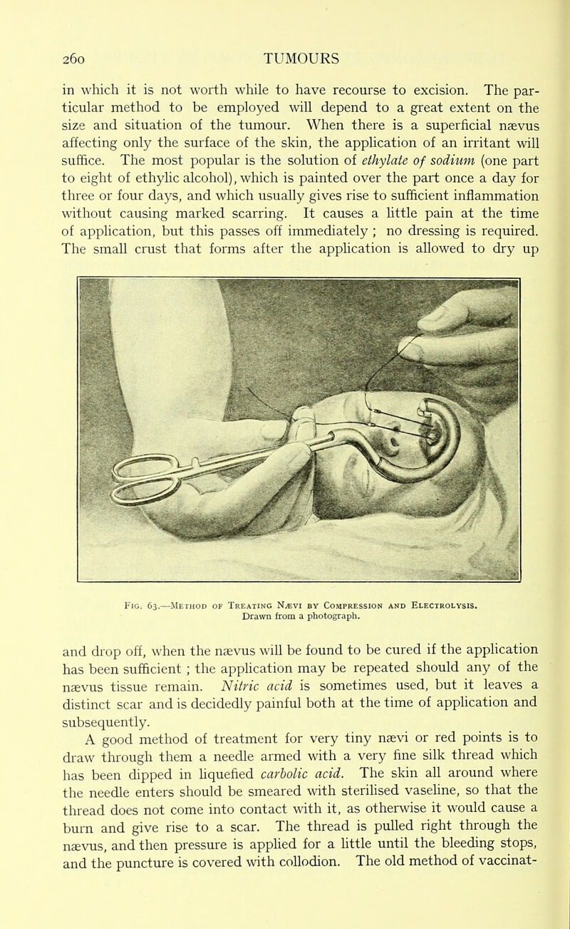 in which it is not worth while to have recourse to excision. The par- ticular method to be employed will depend to a great extent on the size and situation of the tumour. When there is a superficial nsevns affecting only the surface of the skin, the application of an irritant will suffice. The most popular is the solution of ethylaie of sodium (one part to eight of ethylic alcohol), which is painted over the part once a day for three or four days, and which usually gives rise to sufficient inflammation without causing marked scarring. It causes a little pain at the time of application, but this passes off immediately ; no dressing is required. The small crust that forms after the application is allowed to dry up Fig. 63.—Method of Treating I^mvi by Compression and Electrolysis. Drawn from a photograph. and drop off, when the naevus will be found to be cured if the appUcation has been sufficient ; the apphcation may be repeated should any of the naevus tissue remain. Niiric acid is sometimes used, but it leaves a distinct scar and is decidedly painful both at the time of apphcation and subsequently. A good method of treatment for very tiny nasvi or red points is to draw through them a needle armed with a very fine silk thread which has been dipped in liquefied carbolic acid. The skin all around where the needle enters should be smeared with steriUsed vaseline, so that the thread does not come into contact with it, as otherwise it would cause a burn and give rise to a scar. The thread is pulled right through the nsvus, and then pressure is applied for a little until the bleeding stops, and the puncture is covered with collodion. The old method of vaccinat-