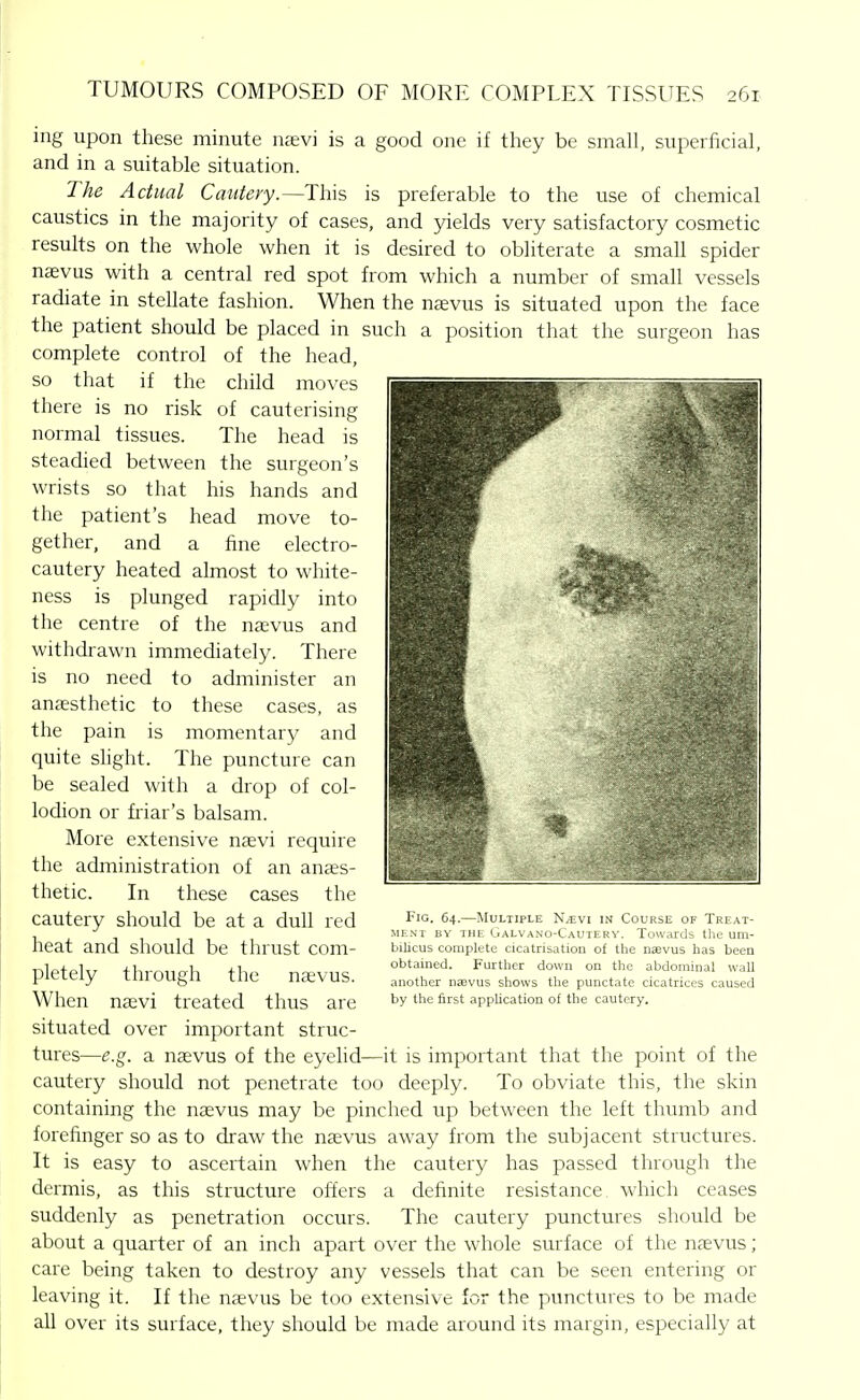 ing upon these minute nfevi is a good one if they be small, superficial, and in a suitable situation. The Actual Cmitery.—This is preferable to the use of chemical caustics in the majority of cases, and yields very satisfactory cosmetic results on the whole when it is desired to obliterate a small spider naevus with a central red spot from which a number of small vessels radiate in stellate fashion. When the ntevus is situated upon the face the patient should be placed in such a position that the surgeon has complete control of the head, so that if the child moves there is no risk of cauterising normal tissues. The head is steadied between the surgeon's wrists so that his hands and the patient's head move to- gether, and a fine electro- cautery heated almost to white- ness is plunged rapidly into the centre of the naevus and withdrawn immediately. There is no need to administer an anaesthetic to these cases, as the pain is momentary and quite slight. The puncture can be sealed with a drop of col- lodion or fiuar's balsam. More extensive naevi require the administration of an anaes- thetic. In these cases the cautery should be at a dull red heat and should be thrust com- pletely through the naevus. When naevi treated thus are situated over important struc- tures—e.g. a naevus of the eyelid—it is important that the point of the cautery should not penetrate too deeply. To obviate this, the skin containing the nsvus may be pinched up between the left thumb and forefinger so as to draw the ntevus away from the subjacent structures. It is easy to ascertain when the cautery has passed through the dermis, as this structure offers a definite resistance which ceases suddenly as penetration occurs. The cautery punctures should be about a quarter of an inch apart over the whole surface of the naevus; care being taken to destroy any vessels that can be seen entering or leaving it. If the naevus be too extensive for the punctures to be made all over its surface, they should be made around its margin, especially at Fig. 64.—Multiple N.ivi in Course of Treat- ment BY THE LrALVANO-CAUTERV. Towards the um- bilicus complete cicatrisation of the naevus has been obtained. Further down on the abdominal wall another naevus shows the punctate cicatrices caused by the first application of the cautery.