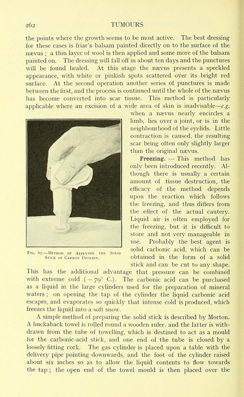 the points where the growth seems to be most active. The best dressing for these cases is hiar's balsam painted directly on to the surface of the ngevus ; a thin layer of wool is then applied and some more of the balsam painted on. The dressing will fall off in about ten days and the punctures will be found healed. At this stage the neevus presents a speckled appearance, with white or pinkish spots scattered over its bright red surface. At the second operation another series of punctures is made between the first, and the process is continued until the whole of the naevus has become converted into scar tissue. This method is particularly applicable where an excision of a wide area of skin is inadvisable—e.g. when a naevus nearly encircles a limb, lies over a joint, or is in the neighbourhood of the eyelids. Little contraction is caused, the resulting scar being often only slightly larger than the original naevus. Freezing. — This method has only been introduced recently. Al- though there is usually a certain amount of tissue destruction, the efficacy of the method depends upon the reaction which follows the freezing, and thus differs from the effect of the actual cautery. Liquid air is often employed for the freezing, but it is difficult to store and not very manageable in use. Probably the best agent is solid carbonic acid, which can be tia. 65.—Method of Applying the Solid Stick of Carbon Dioxide, obtained in the form of a solid stick and can be cut to any shape. This has the additional advantage that pressure can be combined with extreme cold ( - 79° C). The carbonic acid can be purchased as a liquid in the large cylinders used for the preparation of mineral waters ; on opening the tap of the cylinder the Hquid carbonic acid escapes, and evaporates so quickly that intense cold is produced, which freezes the liquid into a soft snow. A simple method of preparing the solid stick is described by Morton. A huckaback towel is rolled round a wooden ruler, and the latter is with- drawn from the tube of towelling, which is destined to act as a mould for the carbonic-acid stick, and one end of the tube is closed by a loosely fitting cork. The gas cylinder is placed upon a table with the delivery pipe pointing downwards, and the foot of the cylinder raised about six inches so as to allow the liquid contents to flow towards the tap ; the open end of the towel mould is then placed over the