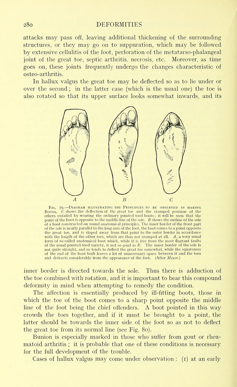 attacks may pass off, leaving additional thickening of the surrounding structures, or they may go on to suppuration, which may be followed by extensive cellulitis of the foot, perforation of the metatarso-phalangeal joint of the great toe, septic arthritis, necrosis, etc. Moreover, as time goes on, these joints frequently undergo the changes characteristic of osteo-arthritis. In hallux valgus the great toe may be deflected so as to lie under or over the second ; in the latter case (which is the usual one) the toe is also rotated so that its upper surface looks somewhat inwards, and its Fig. 79.—Diagram illustrating the Principles to be observed in making Boots. C shows the deflection of the great toe and the cramped position of the others entailed by wearing the ordinary pointed-toed boots ; it will be seen that the point of the boot is opposite to the middle line of the sole. B shows the outhne of the sole of a boot constructed on sound anatomical principles. The inner border of the front part of the sole is nearly parallel to the long axis of the foot, the boot comes to a point opposite the great toe, and is sloped away from that point to the outer border in accordance with the length of the other toes, which are thus not cramped at all. A, a very usual form of so-caUed anatomical boot which, while it is free from the most flagrant faults of the usual pointed-toed variety, is not so good as B. The inner border of the sole is not quite straight, and so tends to deflect the great toe somewhat, while the squareness of the end of the boot both leaves a lot of unnecessary space between it and the toes and detracts considerably from the appearance of the foot. (After Meyer.) inner border is directed towards the sole. Thus there is adduction of the toe combined with rotation, and it is important to bear this compound deformity in mind when attempting to remedy the condition. The affection is essentially produced by ill-fitting boots, those in which the toe of the boot comes to a sharp point opposite the middle line of the foot being the chief offenders. A boot pointed in this way crowds the toes together, and if it must be brought to a point, the latter should be towards the inner side of the foot so as not to deflect the great toe from its normal line (see Fig. 80). Bunion is especially marked in those who suffer from gout or rheu- matoid arthritis ; it is probable that one of these conditions is necessary for the full development of the trouble. Cases of hallux valgus may come under observation : (i) at an early A B C