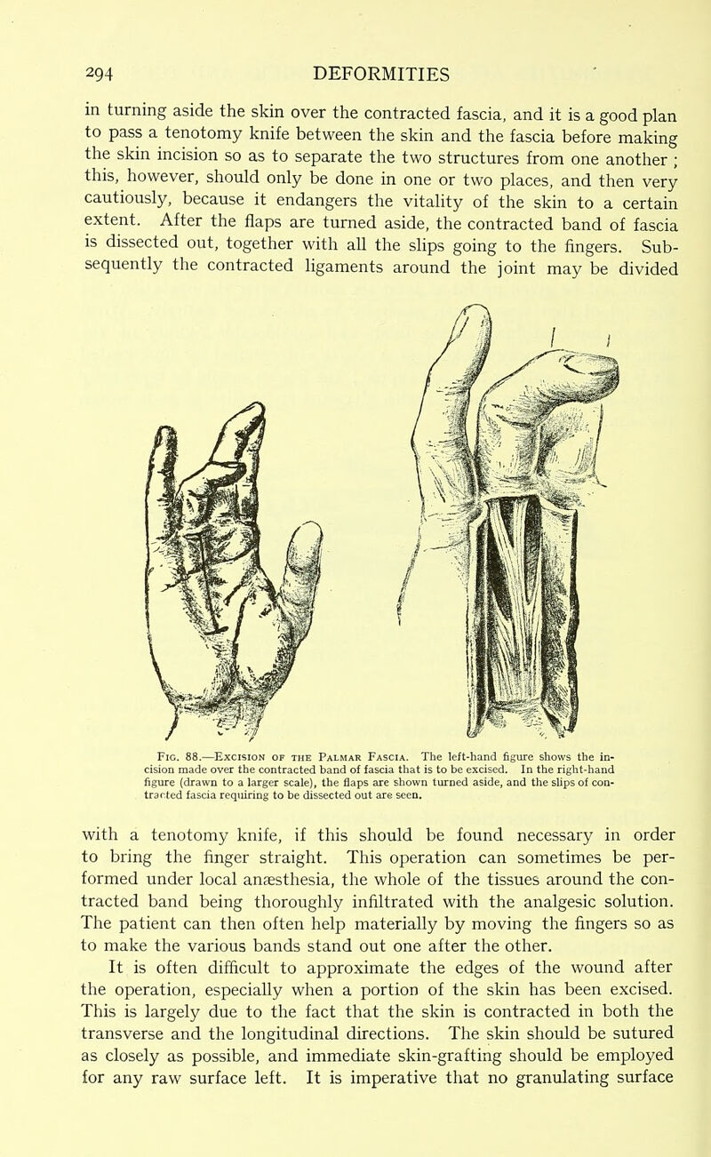 in turning aside the skin over the contracted fascia, and it is a good plan to pass a tenotomy knife between the skin and the fascia before making the skin incision so as to separate the two structures from one another ; this, however, should only be done in one or two places, and then very cautiously, because it endangers the vitality of the skin to a certain extent. After the flaps are turned aside, the contracted band of fascia is dissected out, together with all the slips going to the fingers. Sub- sequently the contracted ligaments around the joint may be divided Fig. 88.—Excision of the Palmar Fascia. The left-hand figure shows the in- cision made over the contracted band of fascia that is to be excised. In the right-hand figure (drawn to a larger scale), the flaps are shown turned aside, and the slips of con- tracted fascia requiring to be dissected out are seen. with a tenotomy knife, if this should be found necessary in order to bring the finger straight. This operation can sometimes be per- formed under local anaesthesia, the whole of the tissues around the con- tracted band being thoroughly infiltrated with the analgesic solution. The patient can then often help materially by moving the fingers so as to make the various bands stand out one after the other. It is often difficult to approximate the edges of the wound after the operation, especially when a portion of the skin has been excised. This is largely due to the fact that the skin is contracted in both the transverse and the longitudinal directions. The skin should be sutured as closely as possible, and immediate skin-grafting should be employed for any raw surface left. It is imperative that no granulating surface