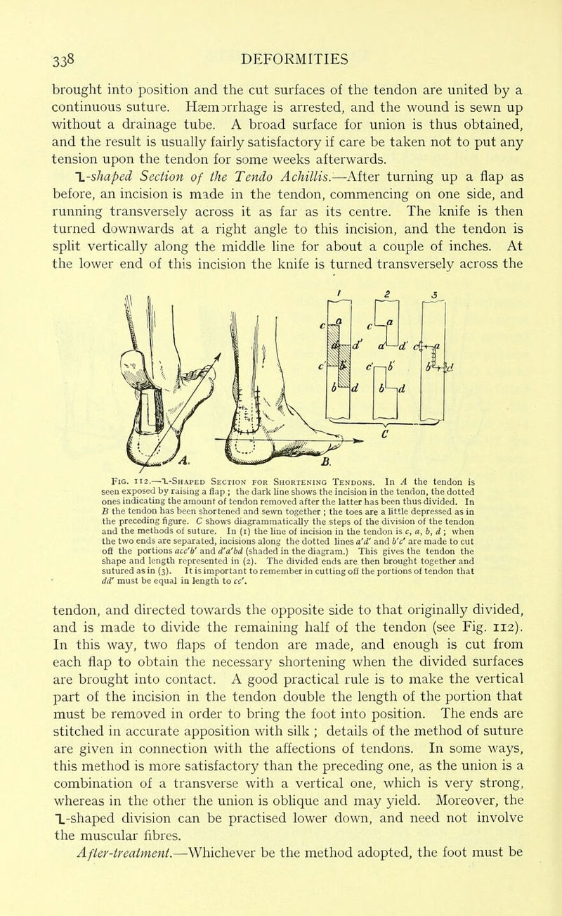 brought into position and the cut surfaces of the tendon are united by a continuous suture. Hasm jrrliage is arrested, and the wound is sewn up without a drainage tube. A broad surface for union is thus obtained, and the result is usually fairly satisfactory if care be taken not to put any tension upon the tendon for some weeks afterwards. l-shaped Section of ihe Tendo A chillis.-—After turning up a flap as before, an incision is made in the tendon, commencing on one side, and running transversely across it as far as its centre. The knife is then turned downwards at a right angle to this incision, and the tendon is split vertically along the middle line for about a couple of inches. At the lower end of this incision the knife is turned transversely across the Fig. 112.—T.-SHAPED Section for Shortening Tendons. In A the tendon is seen exposed by raising a flap ; the dark line shows the incision in the tendon, the dotted ones indicating the amount of tendon removed after the latter has been thus divided. In B the tendon has been shortened and sewn together ; the toes are a little depressed as in the preceding figure. C shows diagrammatically the steps of the division of the tendon and the methods of suture. In (i) the line of incision in the tendon is c, a, b, d; when the two ends are separated, incisions along the dotted lines a'd' and b'c' are made to cut off the portions acc'b' and d'a'bd (shaded in the diagram.) This gives the tendon the shape and length represented in (2). The divided ends are then brought together and sutured as in (3). It is important to remember in cutting off the portions of tendon that dd' must be equal in length to cc'. tendon, and directed towards the opposite side to that originally divided, and is made to divide the remaining half of the tendon (see Fig. 112). In this way, two flaps of tendon are made, and enough is cut from each flap to obtain the necessary shortening when the divided surfaces are brought into contact. A good practical rule is to make the vertical part of the incision in the tendon double the length of the portion that must be removed in order to bring the foot into position. The ends are stitched in accurate apposition with silk ; details of the method of suture are given in connection with the affections of tendons. In some ways, this method is more satisfactory than the preceding one, as the union is a combination of a transverse with a vertical one, which is very strong, whereas in the other the union is oblique and may yield. Moreover, the L-shaped division can be practised lower down, and need not involve the muscular fibres. After-treatment.—Whichever be the method adopted, the foot must be