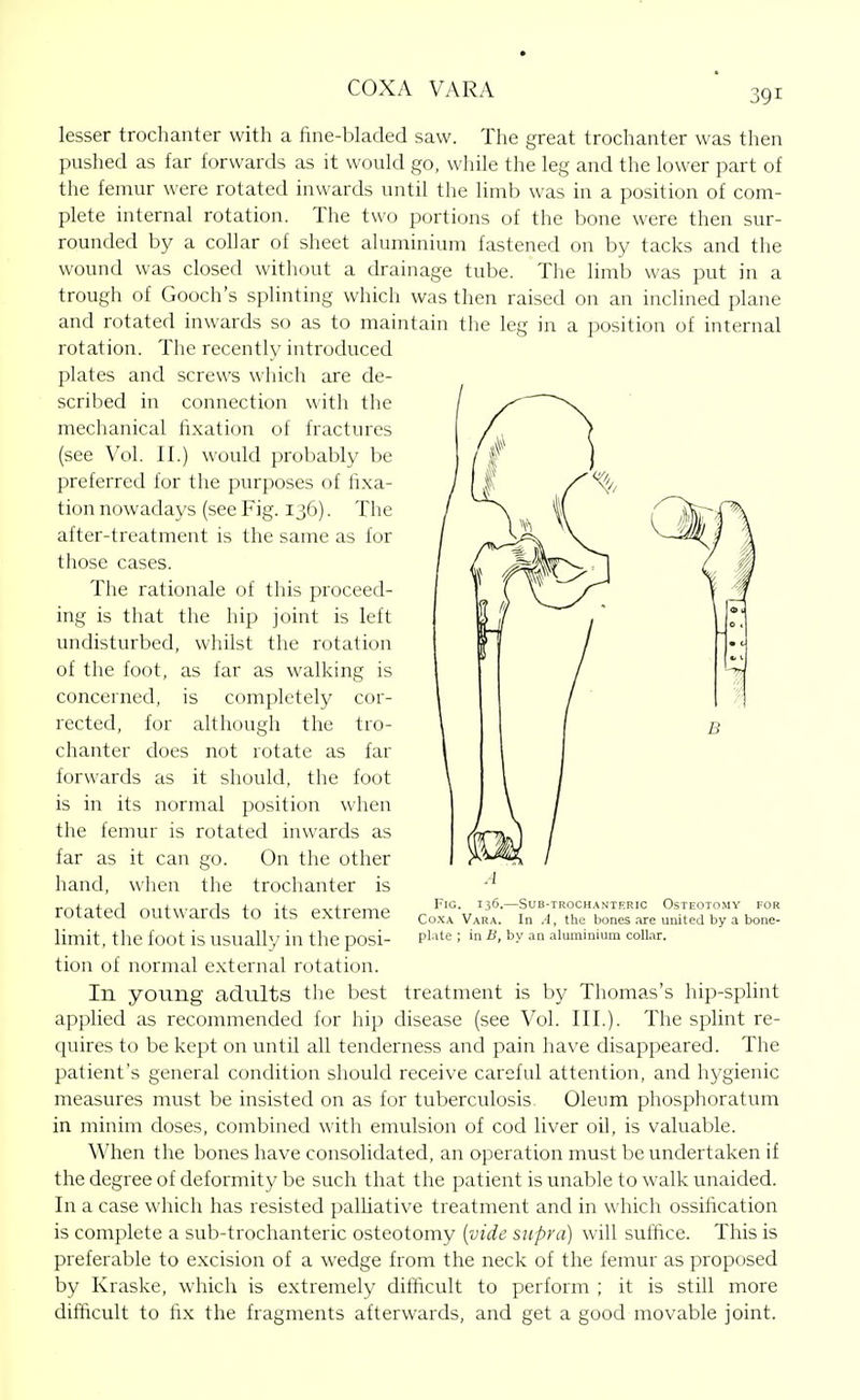 lesser trochanter with a fine-bladed saw. The great trochanter was then pushed as far forwards as it would go, while the leg and the lower part of the femur were rotated inwards until the limb was in a position of com- plete internal rotation. The two portions of the bone were then sur- rounded by a collar of sheet aluminium fastened on by tacks and the wound was closed without a drainage tube. The limb was put in a trough of Gooch's splinting which was then raised on an inclined plane and rotated inwards so as to maintain the leg in a position of internal rotation. The recently introduced plates and screws which are de- scribed in connection with the mechanical fixation of fractures (see Vol. II.) would probably be preferred for the purposes of fi.xa- tion nowadays (see Fig. 136). The after-treatment is the same as for those cases. The rationale of this proceed- ing is that the hip joint is left undisturbed, whilst the rotation of the foot, as far as walking is concerned, is completely cor- rected, for although the tro- chanter does not rotate as far forwards as it should, the foot is in its normal position when the femur is rotated inwards as far as it can go. On the other hand, when the trochanter is rotated outwards to its extreme limit, the foot is usually in the posi- tion of normal external rotation. In young adults the best treatment is by Thomas's hip-splint applied as recommended for hip disease (see Vol. III.). The splint re- quires to be kept on until all tenderness and pain have disappeared. The patient's general condition should receive careful attention, and hygienic measures must be insisted on as for tuberculosis Oleum phosphoratum in minim doses, combined with emulsion of cod liver oil, is valuable. When the bones have consolidated, an operation must be undertaken if the degree of deformity be such that the patient is unable to walk unaided. In a case which has resisted palliative treatment and in which ossihcation is complete a sub-trochanteric osteotomy {vide supra) will suffice. This is preferable to excision of a wedge from the neck of the femur as proposed by Kraske, which is extremely difficult to perform ; it is still more difficult to fix the fragments afterwards, and get a good movable joint. Fig. 136. SUB-TROCHANTKRIC OsTEOTOMY FOR Co.XA Vara. In A, the bones .ire united by a bone- pi.ite ; in B, by an aluminium collar.