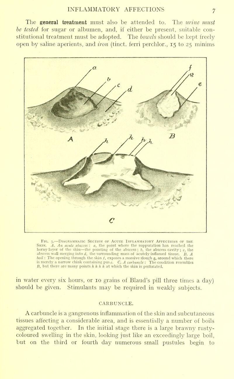 The general treatment must also be attended to. The urine must he tested, for sugar or albumen, and, if either be present, suitable con- stitutional treatment must be adopted. The bowels should be kept freely open by saline aperients, and iron (tinct. ferri perchlor., 15 to 25 minims c Fig. 3.—Diagrammatic Section of Acute Inflammatory Affections of the Skin. A. An acute abscess : a, the point where the suppuration has reached the horny layer of the skin—the pointing of the abscess ; h, the abscess cavity; c, the abscess wall merging into d, the surrounding mass of acutely inflamed tissue. B. A boil: The opening through the skin /, exposes a massive slough g, around which there is merely a narrow chink containing puse. C. A carbtcncle : The condition resembles B, but there are many points h h h It at which the skin is perforated. in water every six hours, or 10 grains of Blaud's pill three times a day) should be given. Stimulants may be required in weakly subjects. CARBUNCLE. A carbuncle is a gangrenous inflammation of the skin and subcutaneous tissues affecting a considerable area, and is essentially a number of boils aggregated together. In the initial stage there is a large brawny rusty- coloured swelling in the skin, looking just like an exceedingly large boil, but on the third or fourth day numerous small pustules begin to