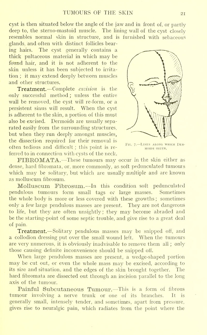 Fig. 7.- LlNES ALONG WHICH DER- MOIDS OCCUR. cyst is then situated below the angle of the jaw and in front of, or partly deep to, the sterno-mastoid muscle. The lining wall of the cyst closely resembles normal skin in structure, and is furnished with sebaceous glands, and often with distinct follicles bear- ing hairs. The cyst generally contains a thick pultaceous material in which may be found hair, and it is not adherent to the skin unless it has been subjected to irrita- tion ; it may extend deeply between muscles and other structures. Treatment.—Complete excision is the only successful method; imless the entire wall be removed, the cyst will re-form, or a persistent sinus will result. When the cyst is adherent to the skin, a portion of this must also be excised. Dermoids are usuaUy sepa- rated easily from the surrounding structures, but when they run deeply amongst muscles, the dissection required for their removal is often tedious and difficult ; this point is re- ferred to in connection with cysts of the neck. FIBROMATA.—These tumours may occur in the skin either as dense, hard fibromata, or, more commonly, as soft pedunculated tumours which may be solitar)', but which are usually multiple and are known as molluscum fibrosum. MoUusciim Fibrosum.—In this condition soft pedunculated pendulous tumours form small tags or large masses. Sometimes the whole body is more or less covered with these growths; sometimes only a few large pendulous masses are present. They are not dangerous to life, but they are often unsightly; they may become abraded and be the starting-point of some septic trouble, and give rise to a great deal of pain. Treatment.—Solitary pendulous masses may be snipped off, and a collodion dressing put over the small wound left. When the tumours are very numerous, it is obviously inadvisable to remove them all ; only those causing definite inconvenience should be snipped off. When large pendulous masses are present, a wedge-shaped portion may be cut out, or even the whole mass may be excised, according to its size and situation, and the edges of the skin brought together. The hard fibromata are dissected out through an incision parallel to the long axis of the tumour. Painful Subcutaneous Tumour.—This is a form of fibrous tumour involving a nerve trunk or one of its branches. It is generally small, intensely tender, and sometimes, apart from pressure, gives rise to neuralgic pain, which radiates from the point where the