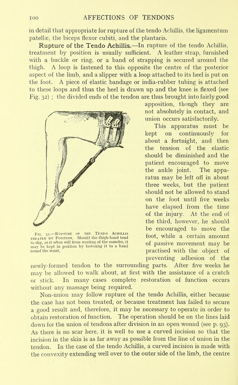 in detail that appropriate for rupture of the tendo AchilHs, the ligamentum patellae, the biceps flexor cubiti, and the plantaris. Rupture of the Tendo Achillis.—In rupture of the tendo Achillis, treatment by position is usually sufficient. A leather strap, furnished with a buckle or ring, or a band of strapping is secured around the thigh. A loop is fastened to this opposite the centre of the posterior aspect of the limb, and a slipper with a loop attached to its heel is put on the foot. A piece of elastic bandage or india-rubber tubing is attached to these loops and thus the heel is drawn up and the knee is flexed (see Fig. 32) ; the divided ends of the tendon are thus brought into fairly good apposition, though they are not absolutely in contact, and union occurs satisfactorily. This apparatus must be kept on continuously for about a fortnight, and then the tension of the elastic should be diminished and the patient encouraged to move the ankle joint. The appa- ratus may be left off in about three weeks, but the patient should not be allowed to stand on the foot until five weeks have elapsed from the time of the injury. At the end of the third, however, he should be encouraged to move the foot, while a certain amount of passive movement may be practised with the object of preventing adhesion of the newly-formed tendon to the surrounding parts. After five weeks he may be allowed to walk about, at first with the assistance of a crutch or stick. In many cases complete restoration of function occurs without any massage being required. Non-union may follow rupture of the tendo Achillis, either because the case has not been treated, or because treatment has failed to secure a good result and, therefore, it may be necessary to operate in order to obtain restoration of function. The operation should be on the lines laid down for the union of tendons after division in an open wound (see p. 93). As there is no scar here, it is well to use a curved incision so that the incision in the skin is as far away as possible from the line of union in the tendon. In the case of the tendo Achillis, a curved incision is made with the convexity extending well over to the outer side of the limb, the centre Fig. 32.—Rupture of the Tendo Achillis TREATED BY POSITION. Should the thigh-band tend to slip, as it often will from wasting of the muscles, it may be kept in position by fastening it to a band round the waist.