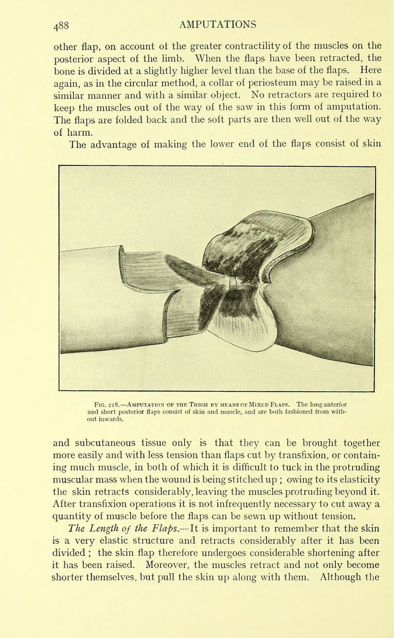 other flap, on account of the greater contractiUty of the muscles on the posterior aspect of the hmb. When the flaps have been retracted, the bone is divided at a shghtly liigher level than the base of the flaps. Here again, as in the circular method, a collar of periosteum may be raised in a similar manner and with a similar object. No retractors are required to keep the muscles out of the way of the saw in this form of amputation. The flaps are folded back and the soft parts are then well out of the way of harm. The advantage of making the lower end of the flaps consist of skin Fig. 2i8.—Amputation of the Thigh by means of Mixed Flaps. The long anterior and short posterior flaps consist of skin and muscle, and are both fashioned from with- out inwards. and subcutaneous tissue only is that they can be brought together more easily and with less tension than flaps cut by transfixion, or contain- ing much muscle, in both of which it is difficult to tuck in the protruding muscular mass when the wound is being stitched up ; owing to its elasticity the skin retracts considerably, leaving the muscles protruding beyond it. After transfixion operations it is not infrequently necessary to cut away a quantity of muscle before the flaps can be sewn up without tension. The Length of the Flaps.—It is important to remember that the skin is a very elastic stracture and retracts considerably after it has been divided ; the skin flap therefore undergoes considerable shortening after it has been raised. Moreover, the muscles retract and not only become shorter themselves, but pull the skin up along with them. Although the