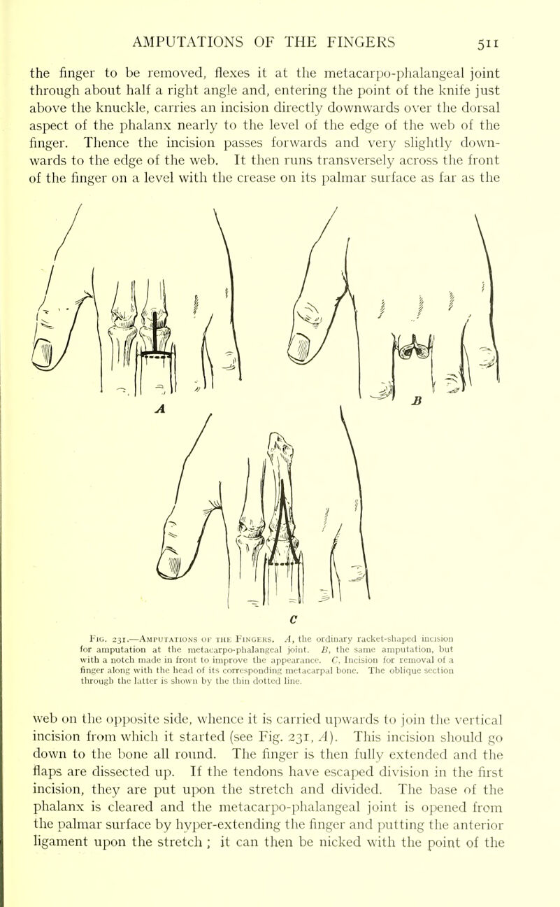 the finger to be removed, flexes it at the metacarpo-phalangeal joint through about half a right angle and, entering the point of the knife just above the knuckle, carries an incision directly downwards over the dorsal aspect of the phalanx nearly to the level of the edge of the web of the finger. Thence the incision passes forwards and very slightly down- wards to the edge of the web. It then runs transversely across the front of the finger on a level with the crease on its palmar surface as far as the C Fig. 231.—Amputations of the Fingers. A, the ordinary racket-shaped incision for amputation at the metacarpo-phalangeal joint. the same amputation, but with a notch made in front to improve the appearance. C. Incision for removal of a finger along \vith the head of its corresponding metacarpal bone. The oblique section through the latter is shown by the thin dotted line. web on the opposite side, whence it is carried upwards to join the vertical incision from which it started (see Fig. 231, A). This incision should go down to the bone all round. The finger is then fully extended and the flaps are dissected up. If the tendons have escaped division in the first incision, they are put upon the stretch and divided. The base of the phalanx is cleared and the metacarpo-phalangeal joint is opened from the palmar surface by hvper-extending the hnger and putting the anterior ligament upon the stretch; it can then be nicked with the point of the