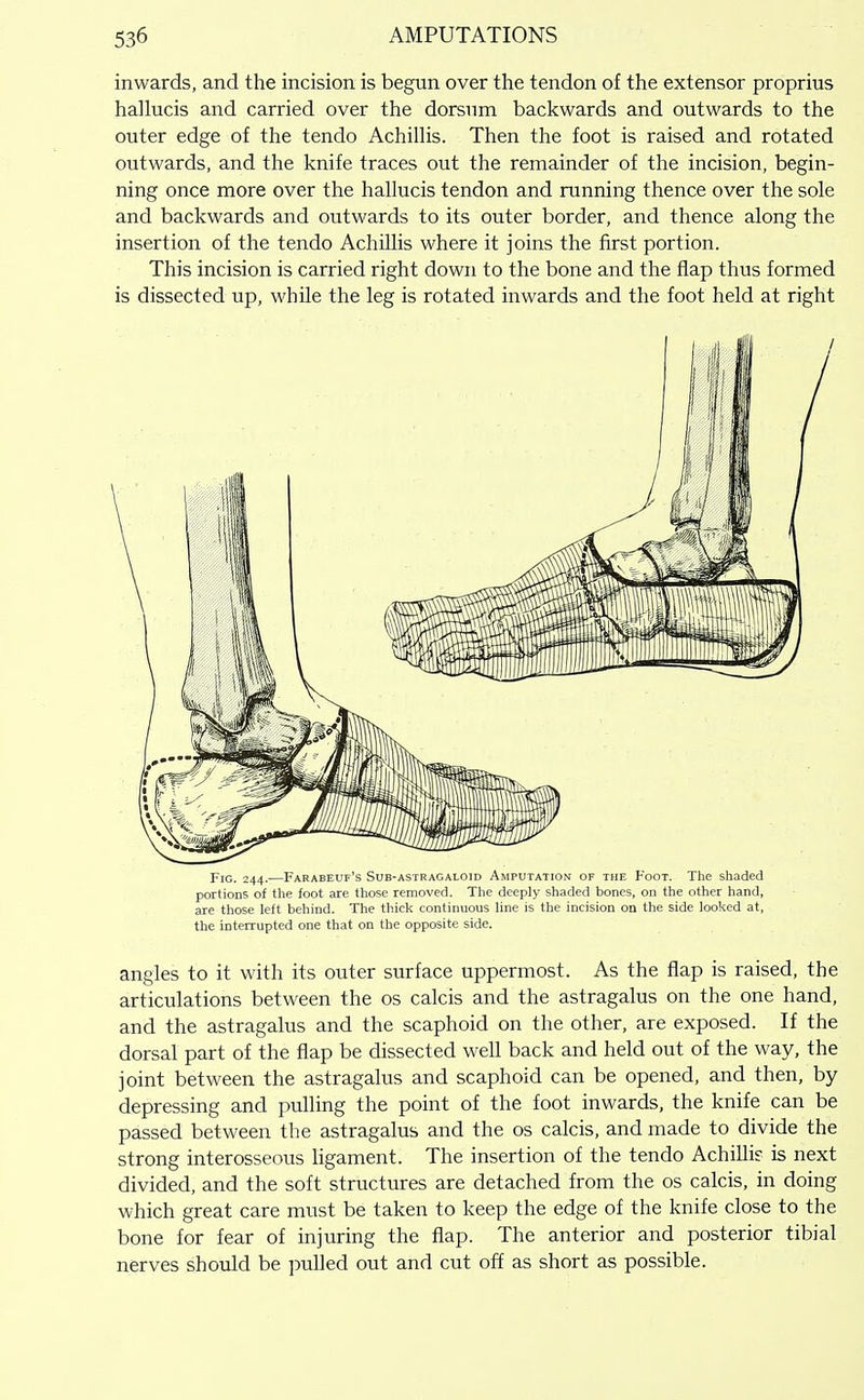 inwards, and the incision is begun over the tendon of the extensor proprius hallucis and carried over the dorsum backwards and outwards to the outer edge of the tendo Achillis. Then the foot is raised and rotated outwards, and the knife traces out the remainder of the incision, begin- ning once more over the hallucis tendon and running thence over the sole and backwards and outwards to its outer border, and thence along the insertion of the tendo Achillis where it joins the first portion. This incision is carried right down to the bone and the flap thus formed is dissected up, whUe the leg is rotated inwards and the foot held at right Fic. 244.—Farabeuf's Sub-astragaloid Amputation of the F'oot. The shaded portions of the foot are those removed. Tlie deeply shaded bones, on the other hand, are those left behind. The thick continuous line is the incision on the side looked at, the interrupted one that on the opposite side. angles to it with its outer surface uppermost. As the flap is raised, the articulations between the os calcis and the astragalus on the one hand, and the astragalus and the scaphoid on the other, are exposed. If the dorsal part of the flap be dissected well back and held out of the way, the joint between the astragalus and scaphoid can be opened, and then, by- depressing and pulling the point of the foot inwards, the knife can be passed between the astragalus and the os calcis, and made to divide the strong interosseous ligament. The insertion of the tendo Achilli? is next divided, and the soft structures are detached from the os calcis, in doing which great care must be taken to keep the edge of the knife close to the bone for fear of injuring the flap. The anterior and posterior tibial nerves should be ])ulled out and cut off as short as possible.