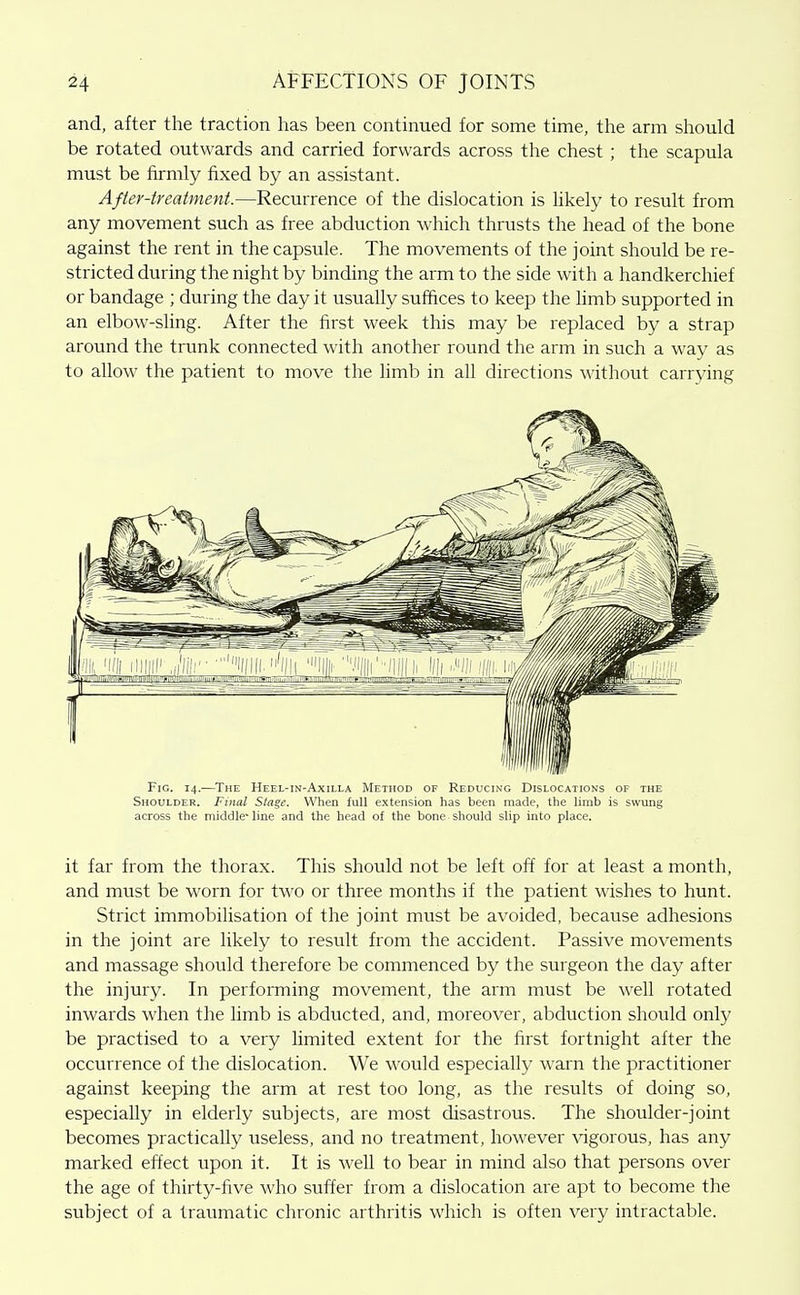 and, after the traction has been continued for some time, the arm should be rotated outwards and carried forwards across the chest ; the scapula must be firmly fixed by an assistant. After-treatment.—Recurrence of the dislocation is hkely to result from any movement such as free abduction which thrusts the head of the bone against the rent in the capsule. The movements of the joint should be re- stricted during the night by binding the arm to the side with a handkerchief or bandage ; during the day it usually suffices to keep the hmb supported in an elbow-sling. After the first week this may be replaced by a strap around the trunk connected with another round the arm in such a way as to allow the patient to move the limb in all directions without carrying Fig. 14.—The Heel-in-Axilla Method of Reducing Dislocations of the Shoulder. Final Stage. When full extension has been made, the limb is swung across the middle-line and the head of the bone should slip into place. it far from the thorax. This should not be left off for at least a month, and must be worn for two or three months if the patient wishes to hunt. Strict immobilisation of the joint must be avoided, because adhesions in the joint are likely to result from the accident. Passive movements and massage should therefore be commenced by the surgeon the day after the injury. In performing movement, the arm must be well rotated inwards when the limb is abducted, and, moreover, abduction should only be practised to a very limited extent for the first fortnight after the occurrence of the dislocation. We would especially warn the practitioner against keeping the arm at rest too long, as the results of doing so, especially in elderly subjects, are most disastrous. The shoulder-joint becomes practically useless, and no treatment, however vigorous, has any marked effect upon it. It is well to bear in mind also that persons over the age of thirty-five who suffer from a dislocation are apt to become the subject of a traumatic chronic arthritis which is often very intractable.