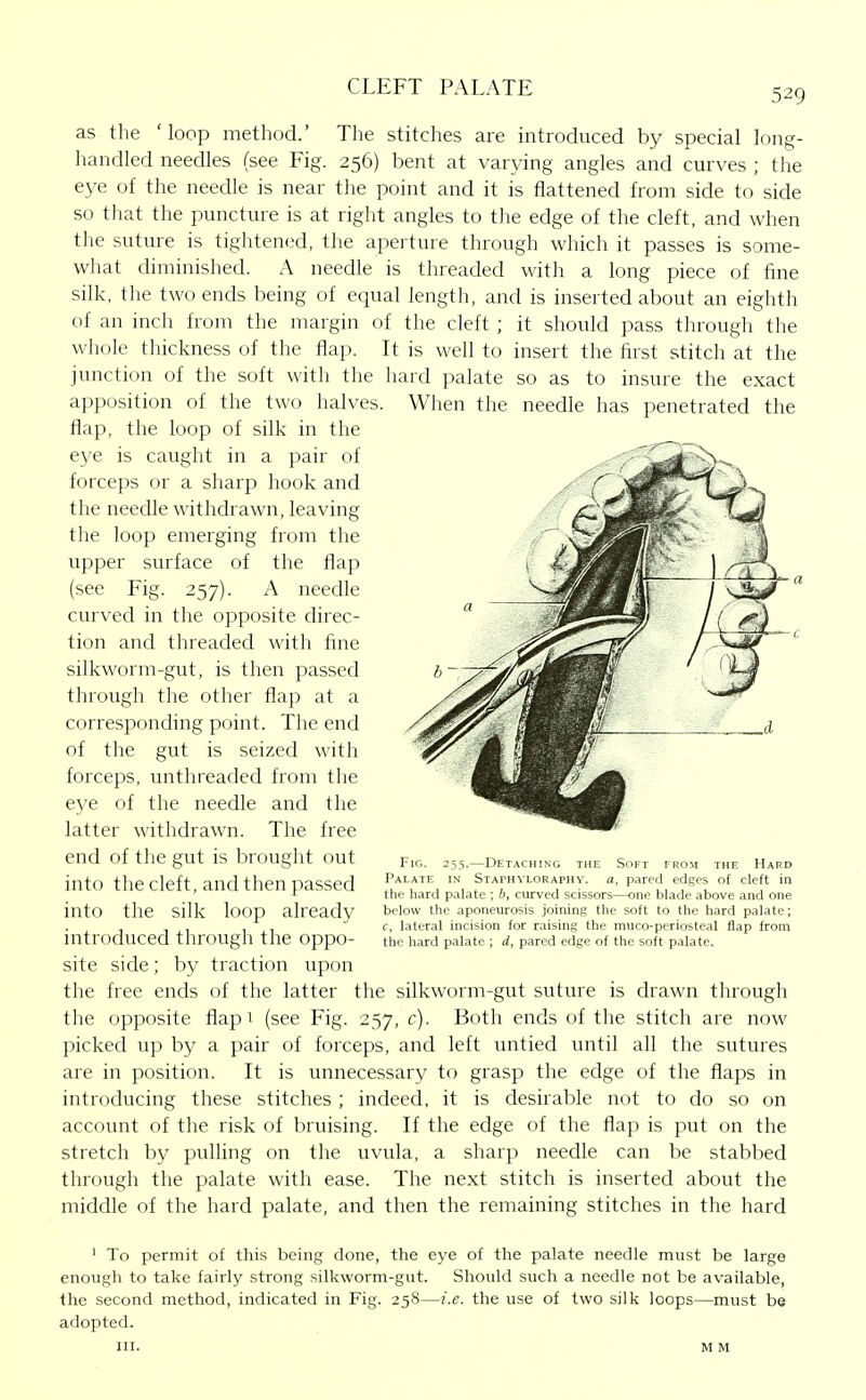 as the 'loop method.' The stitches are introduced by special long- handled needles (see Fig. 256) bent at varying angles and curves ; the eye of the needle is near tlie point and it is flattened from side to side so that the puncture is at right angles to the edge of the cleft, and when the suture is tightened, the aperture through which it passes is some- what diminished. A needle is threaded with a long piece of fine silk, the two ends being of equal length, and is inserted about an eighth of an inch from the margin of the cleft ; it should pass through the whole thickness of the flap. It is well to insert the first stitch at the junction of the soft with the hard palate so as to insure the exact apposition of the two halves. When the needle has penetrated the flap, the loop of silk in the eye is caught in a pair of forceps or a sharp hook and the needle withdrawn, leaving the loop emerging from the upper surface of the flap (see Fig. 257). A needle ciu-ved in the opposite direc- tion and threaded with fine silkworm-gut, is then passed through the other flap at a corresponding point. The end of the gut is seized with forceps, unthreaded from the eye of the needle and the latter withdrawn. The free end of the gut is brought out into the cleft, and then passed into the silk loop already introduced through the oppo- site side; by traction upon the free ends of the latter the silkworm-gut suture is drawn through the opposite flap 1 (see Fig. 257, c). Both ends of the stitch are now picked up by a pair of forceps, and left untied until all the sutures are in position. It is unnecessary to grasp the edge of the flaps in introducing these stitches; indeed, it is desirable not to do so on accoimt of the risk of bruising. If the edge of the flap is put on the stretch by pulhng on the uvula, a sharp needle can be stabbed through the palate with ease. The next stitch is inserted about the middle of the hard palate, and then the remaining stitches in the hard Fig. 255.—Detaching the Soft trom the Hard Palate in Stafhvloraphy. a, pared edges of cleft in the liard palate ; b, curved scissors—one blade above and one below the aponeurosis joining the soft to the hard palate; f, lateral incision for raising the muco-periosteal flap from the liard palate ; d, pared edge of the soft palate. ' To permit of this being done, the eye of the palate needle must be large enough to take fairly strong silkworm-gut. Should such a needle not be available, the second method, indicated in Fig. 258—i.e. the use of two silk loops—must be adopted.