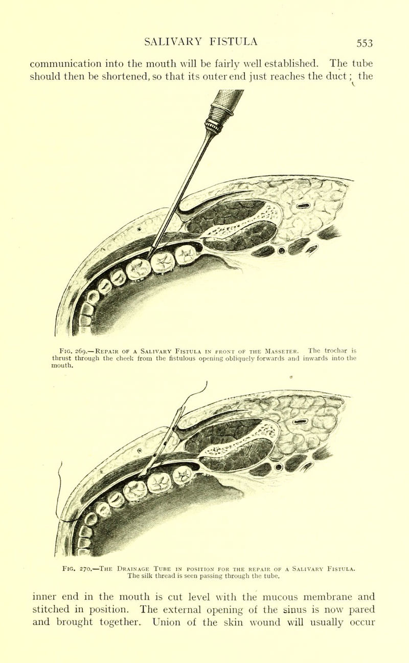 communication into the mouth will be fairly well established. The tube should then be shortened, so that its outer end just reaches the duct; the Fig. 269.— Repair of a Salivary Fistula in front of the Masseter. The trochar is thrust through the cheek from the fistulous opening obliquely forwards and inwards into the mouth. Fig. 270.—^The Drainage Tube in position for the repair of a Salivary Fistula. The silk thread is seen passing through the tube. inner end in the mouth is cut level with the mucous membrane and stitched in position. The external opening of the sinus is now pared and brought together. LTnion of the skin wound will usually occur