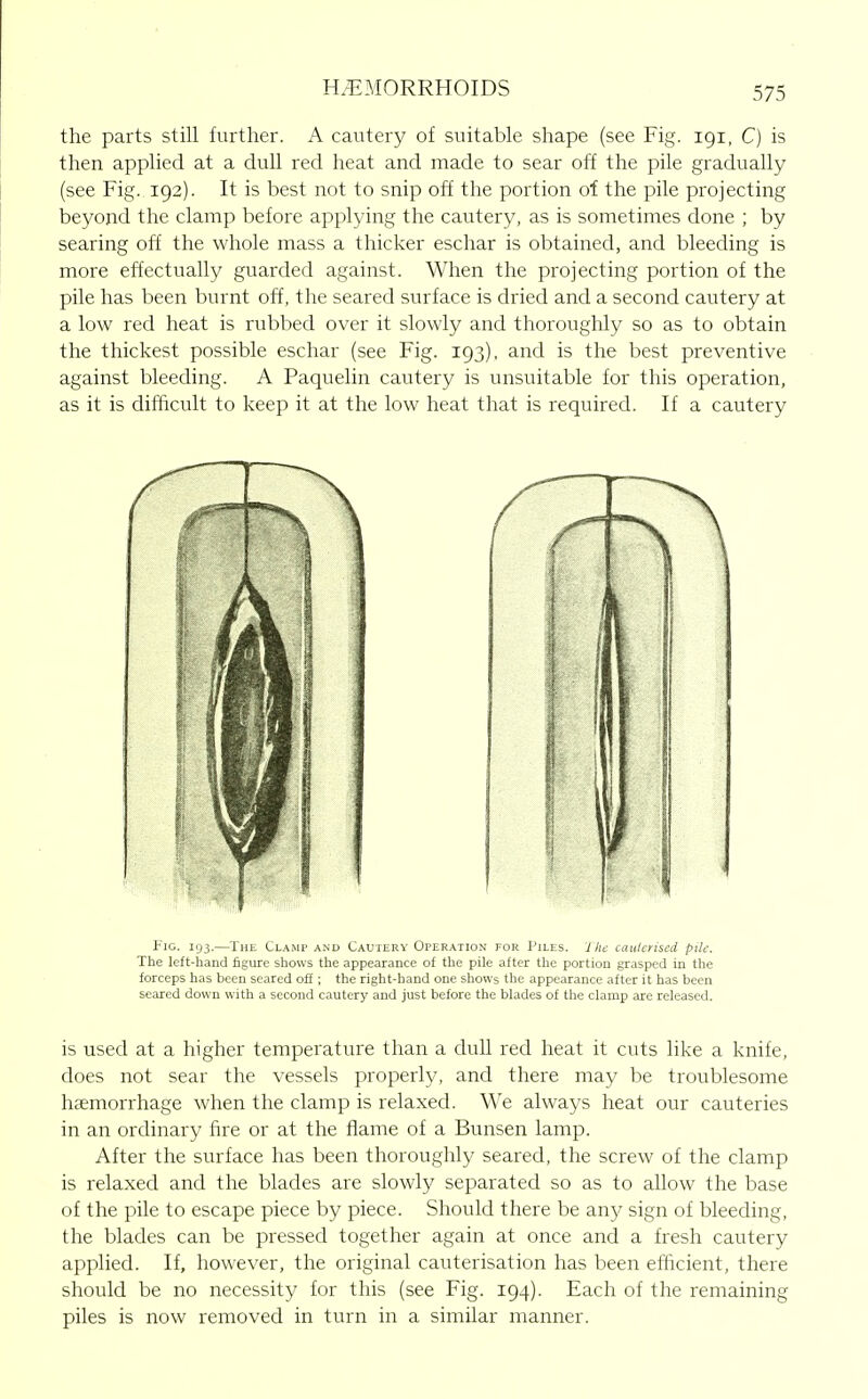 the parts still further. A cautery of suitable shape (see Fig. 191, C) is then applied at a dull red heat and made to sear off the pile gradually (see Fig. 192). It is best not to snip off the portion of the pile projecting beyond the clamp before applying the cautery, as is sometimes done ; by searing off the whole mass a thicker eschar is obtained, and bleeding is more effectually guarded against. When the projecting portion of the pile has been burnt off, the seared surface is dried and a second cautery at a low red heat is rubbed over it slowly and thoroughly so as to obtain the thickest possible eschar (see Fig. 193), and is the best preventive against bleeding. A Paquelin cautery is unsuitable for this operation, as it is difficult to keep it at the low heat that is required. If a cautery Fig. 193.—The Clamp and Cautery Operation for I'iles. 1 he cauterised pile. The left-hand figure shows the appearance of the pile after the portion grasped in the forceps has been seared off; the right-hand one shows the appearance after it has been seared down with a second cautery and just before the blades of the clamp are released. is used at a higher temperature than a dull red heat it cuts like a knife, does not sear the vessels properly, and there may be troublesome haemorrhage when the clamp is relaxed. We always heat our cauteries in an ordinary fire or at the flame of a Bunsen lamp. After the surface has been thoroughly seared, the screw of the clamp is relaxed and the blades are slowly separated so as to allow the base of the pile to escape piece by piece. Should there be any sign of bleeding, the blades can be pressed together again at once and a fresh cautery applied. If, however, the original cauterisation has been efficient, there should be no necessity for this (see Fig. 194). Each of the remaining piles is now removed in turn in a similar manner.
